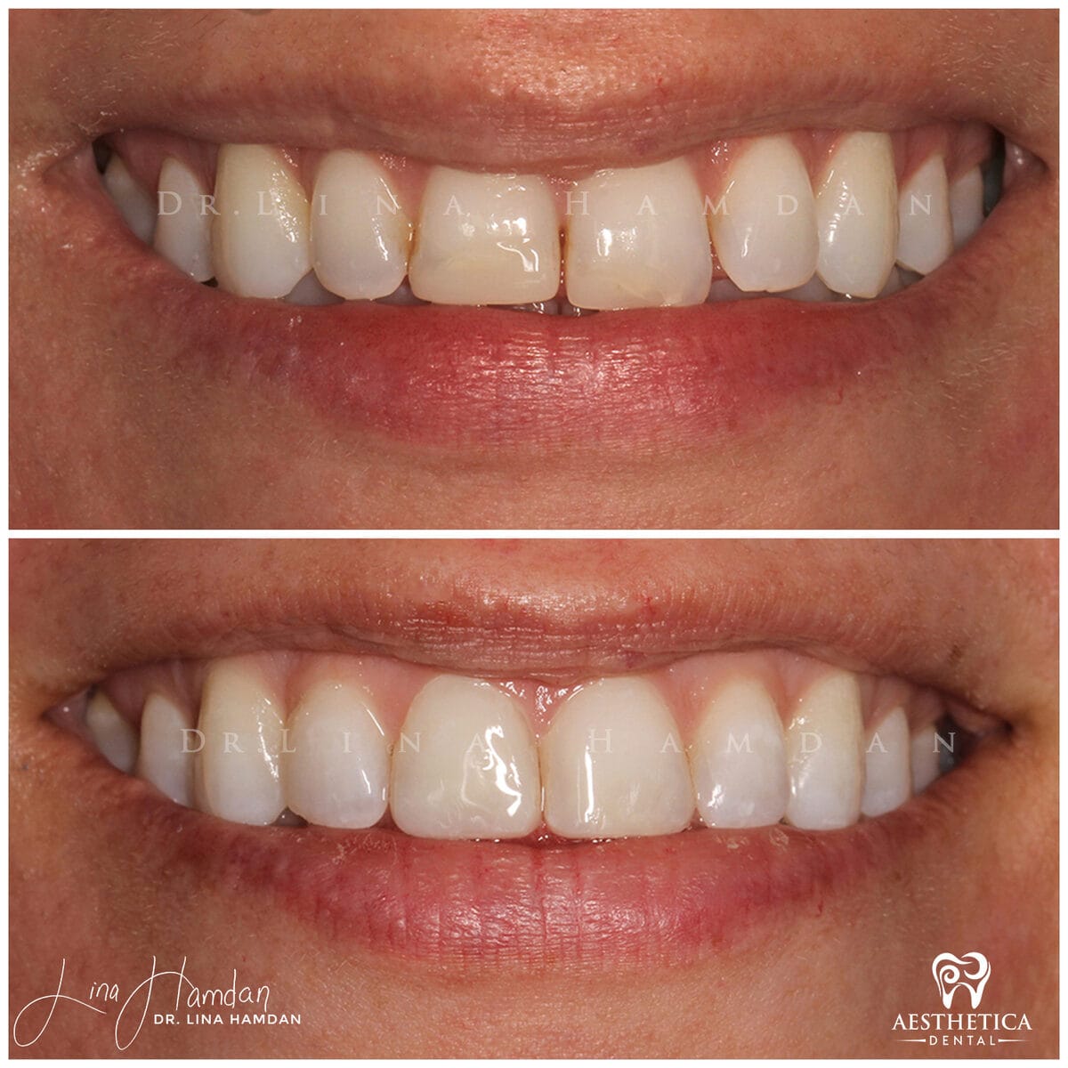Composite bonding: anonymous case 95 from Aesthetica Dental Naperville