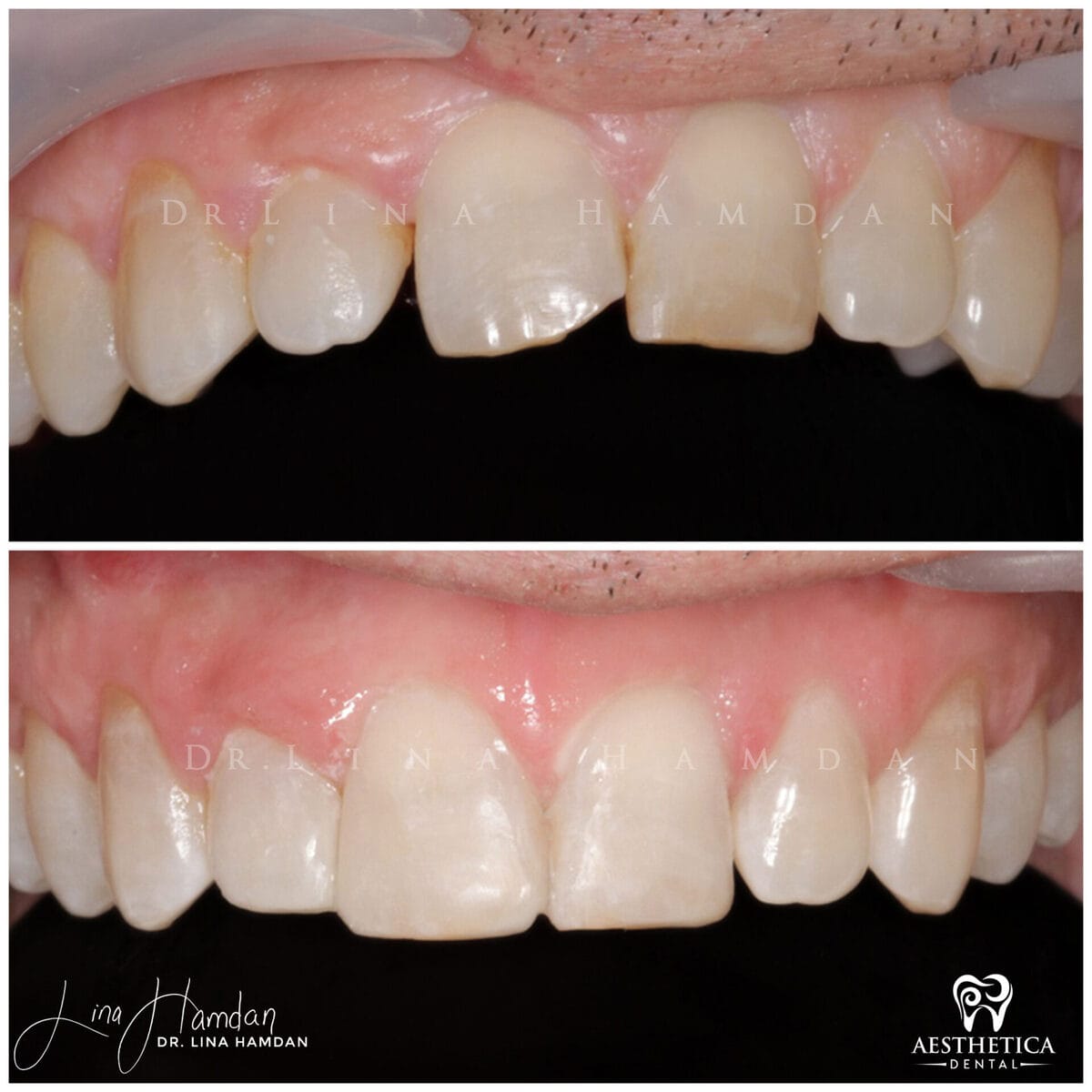 Composite bonding: anonymous case 97 from Aesthetica Dental Naperville