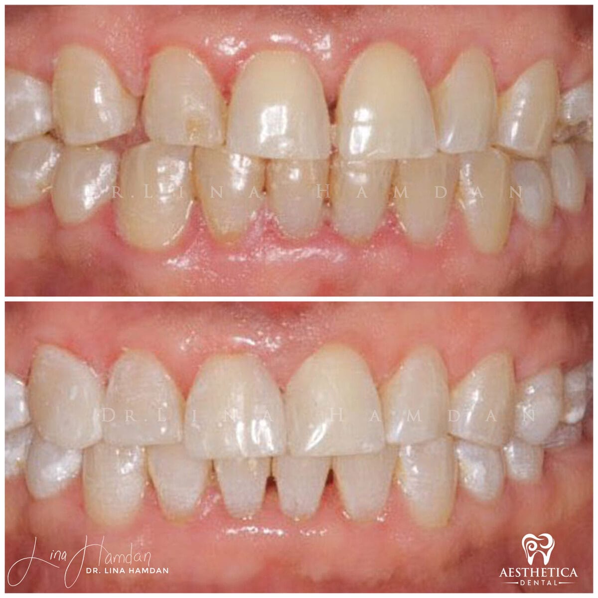Composite bonding: anonymous case 105 from Aesthetica Dental Naperville