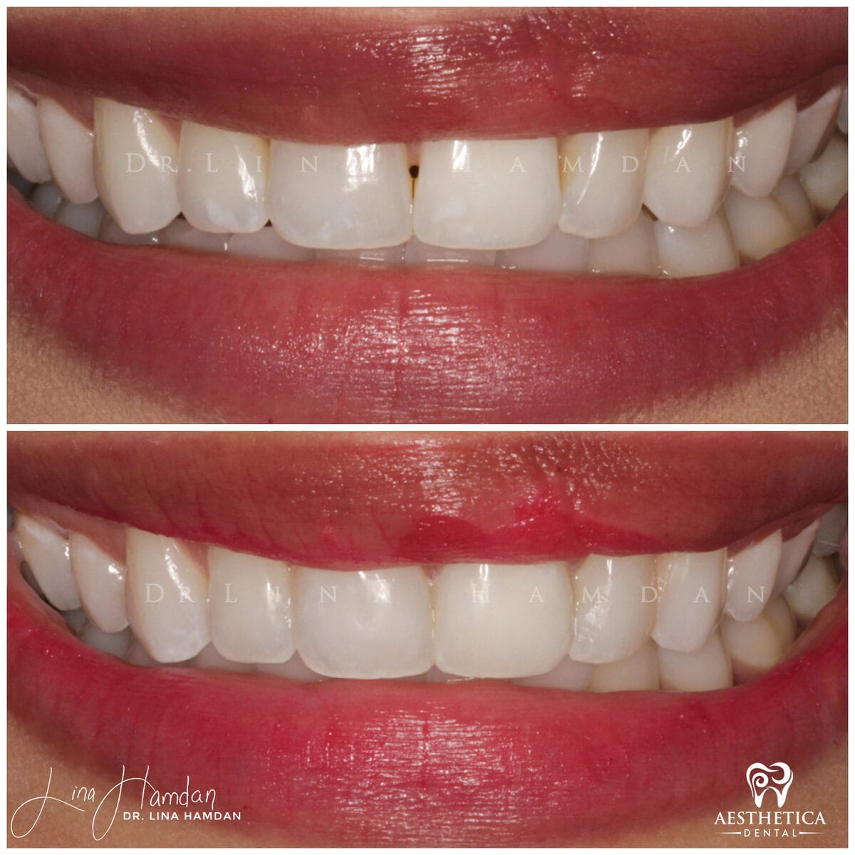 Composite bonding: anonymous case 106 from Aesthetica Dental Naperville