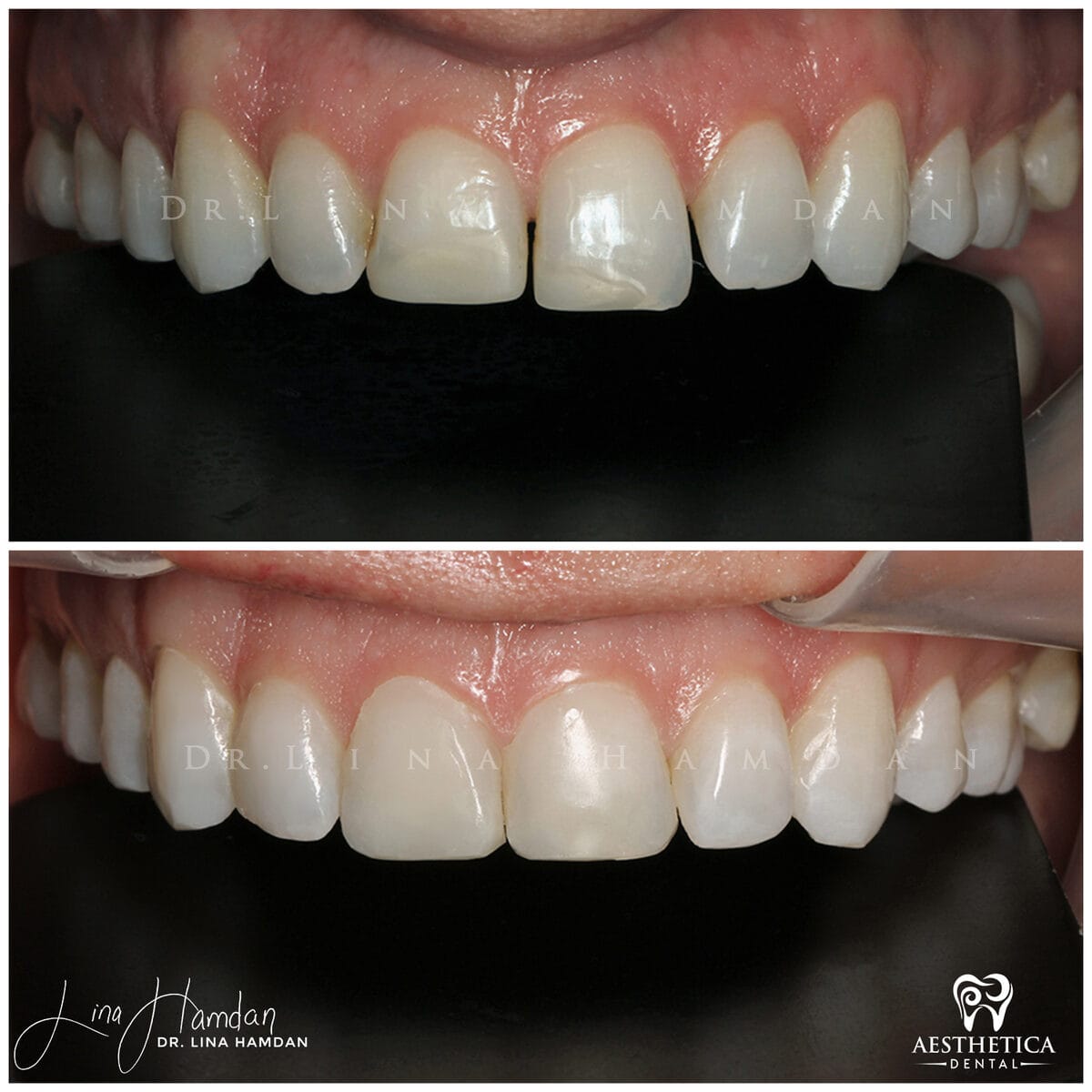 Composite bonding: anonymous case 110 from Aesthetica Dental Naperville