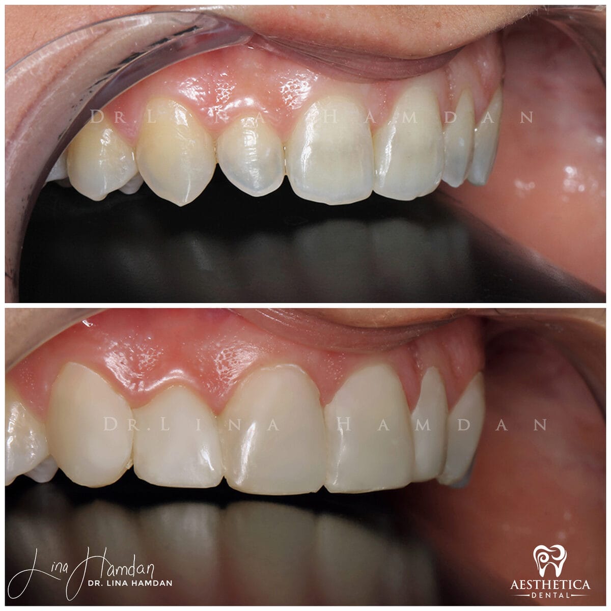 Composite bonding: anonymous case 114 from Aesthetica Dental Naperville