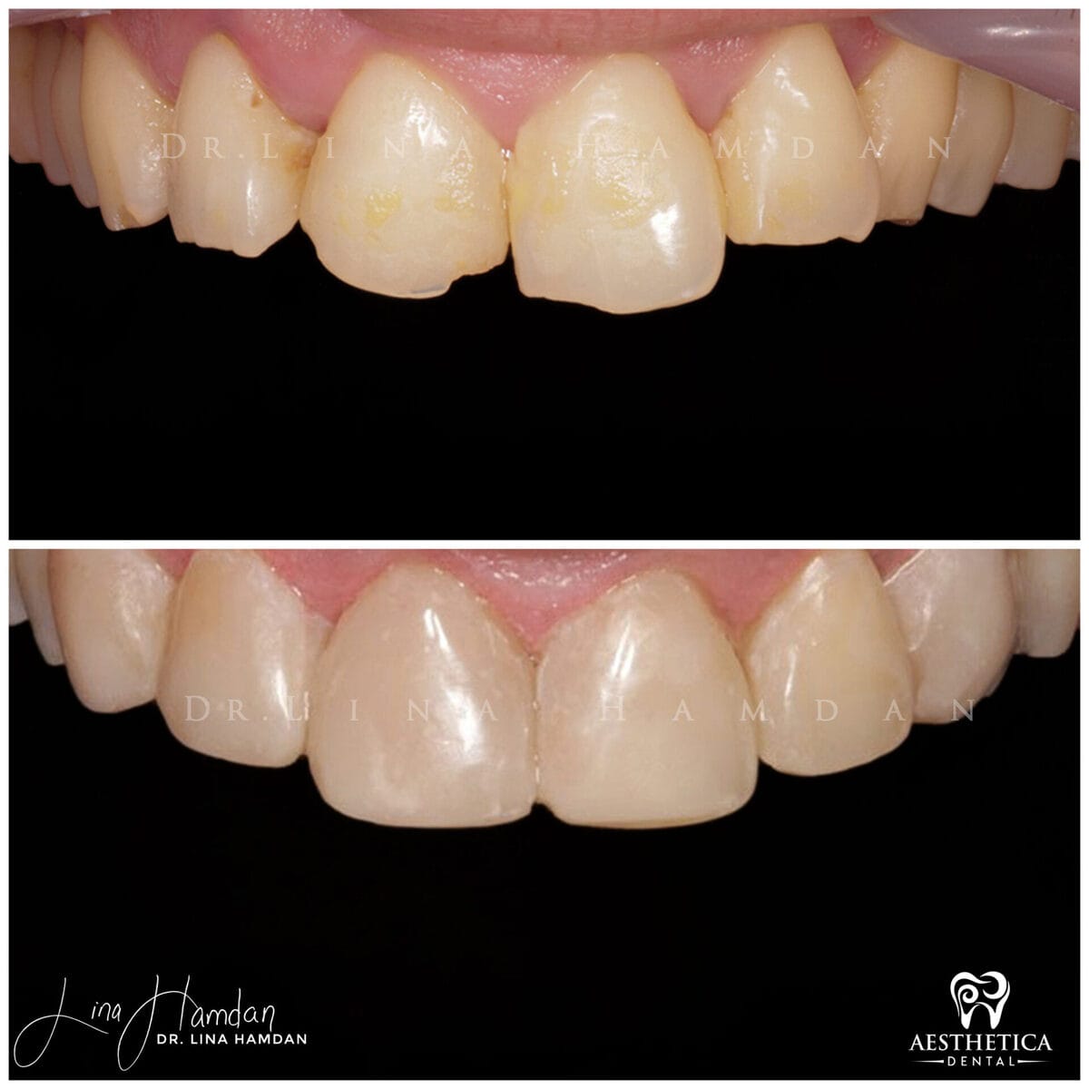 Composite bonding: anonymous case 117 from Aesthetica Dental Naperville