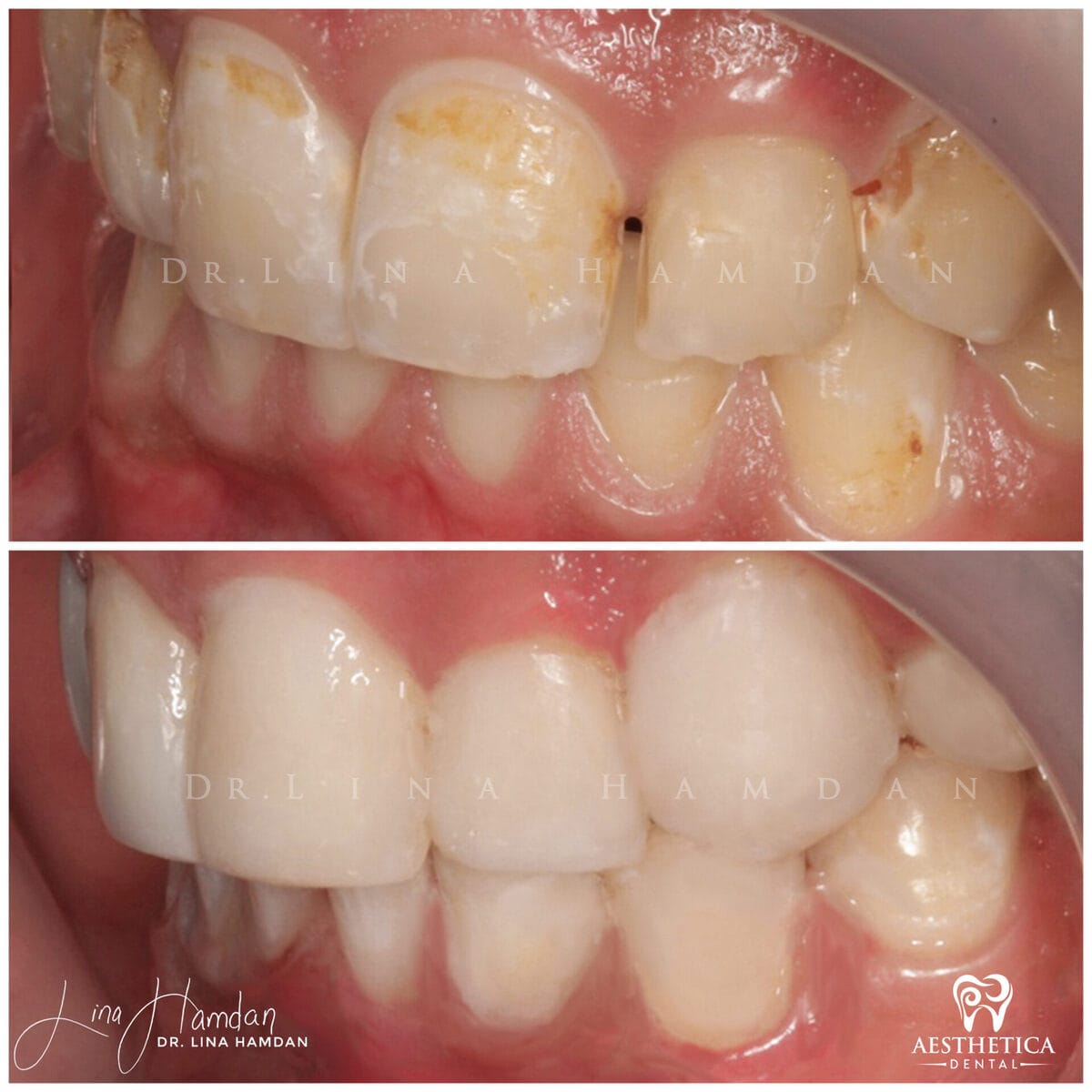 Composite bonding: anonymous case 124 from Aesthetica Dental Naperville