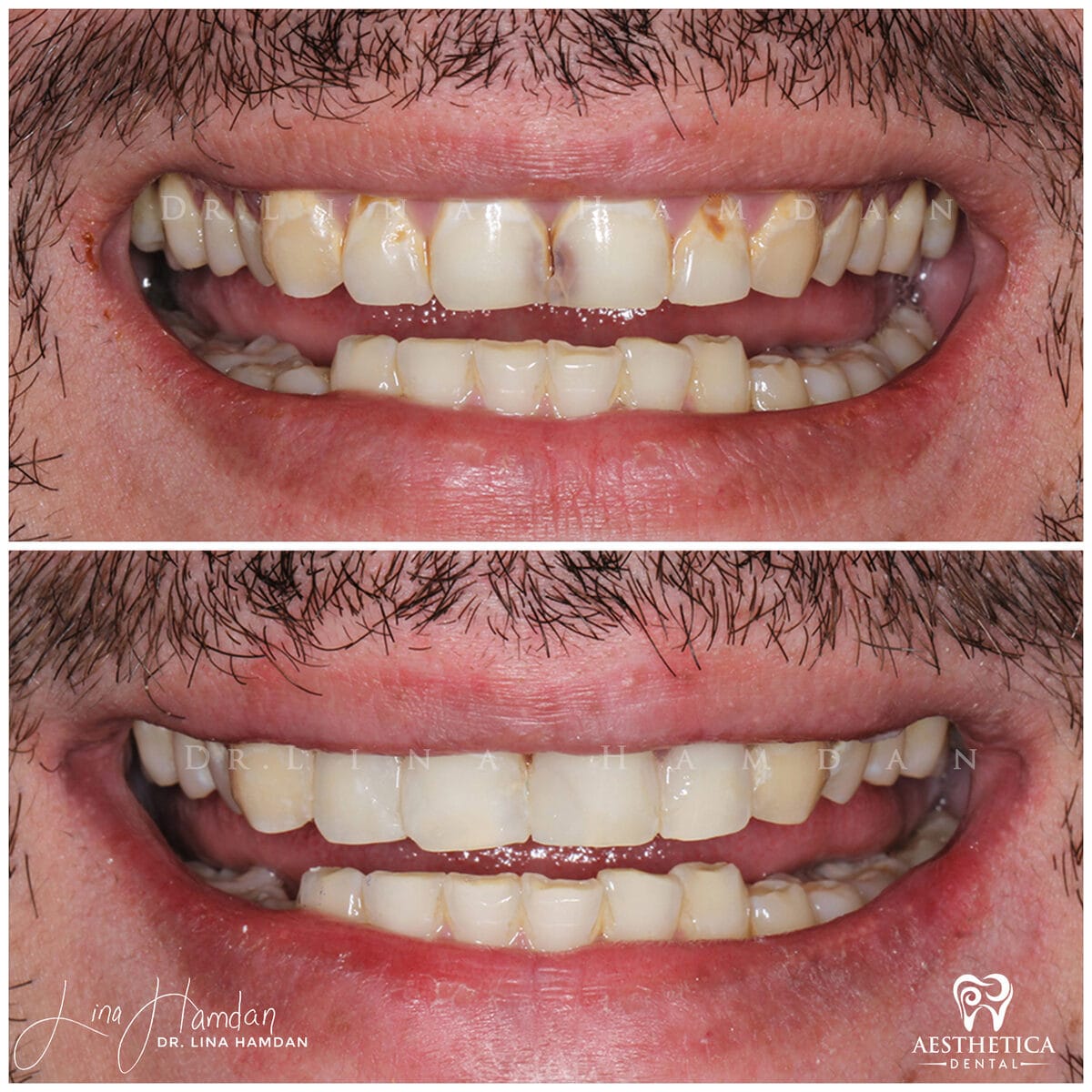 Composite bonding: anonymous case 125 from Aesthetica Dental Naperville