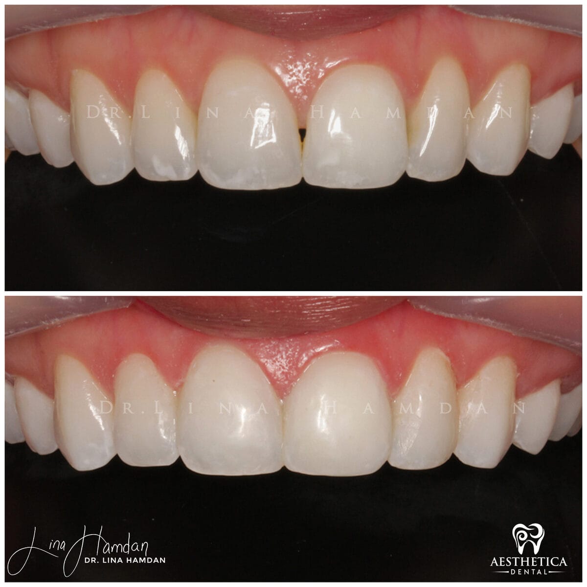 Composite bonding: anonymous case 151 from Aesthetica Dental Naperville