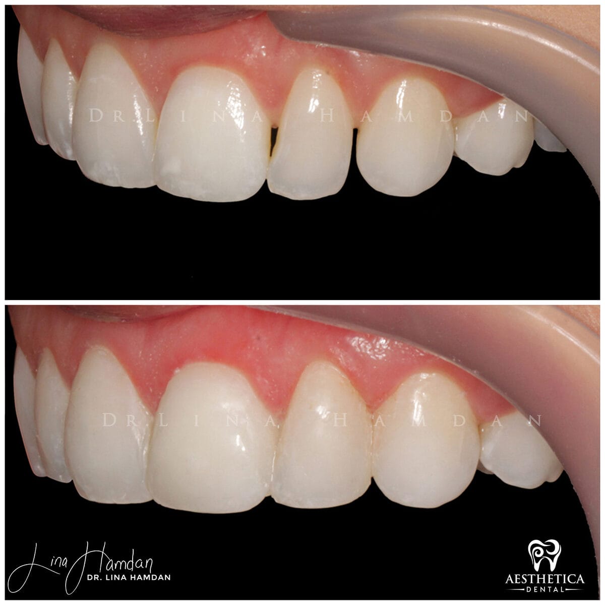 Composite bonding: anonymous case 153 from Aesthetica Dental Naperville