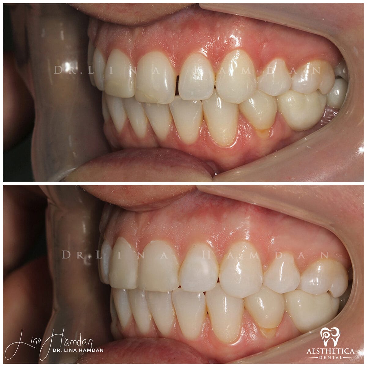 Composite bonding: anonymous case 157 from Aesthetica Dental Naperville