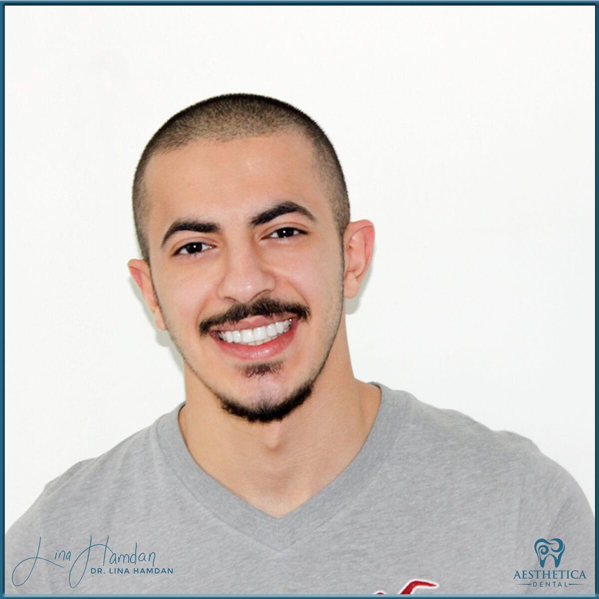 Composite bonding: anonymous case 160 from Aesthetica Dental Naperville