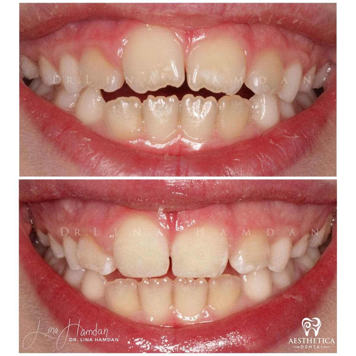 Pediatric dentistry visit, anonymous patient at Aesthetica Dental Naperville (case 2, 2025-05-1-2-1)