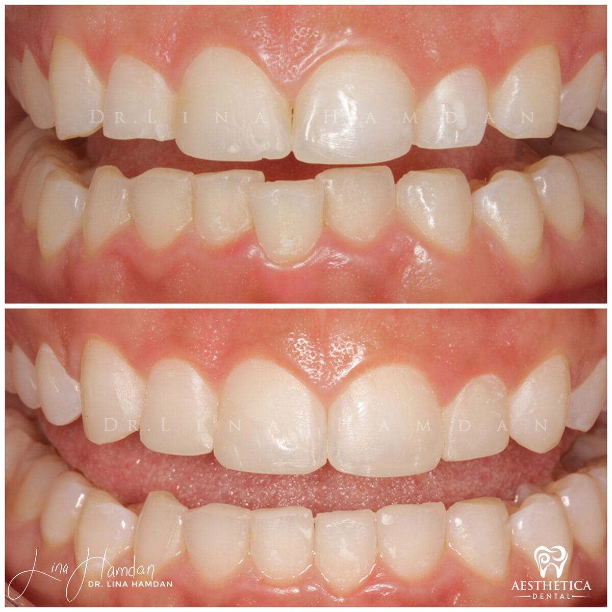 Inman aligners: anonymous case 15 from Aesthetica Dental Naperville