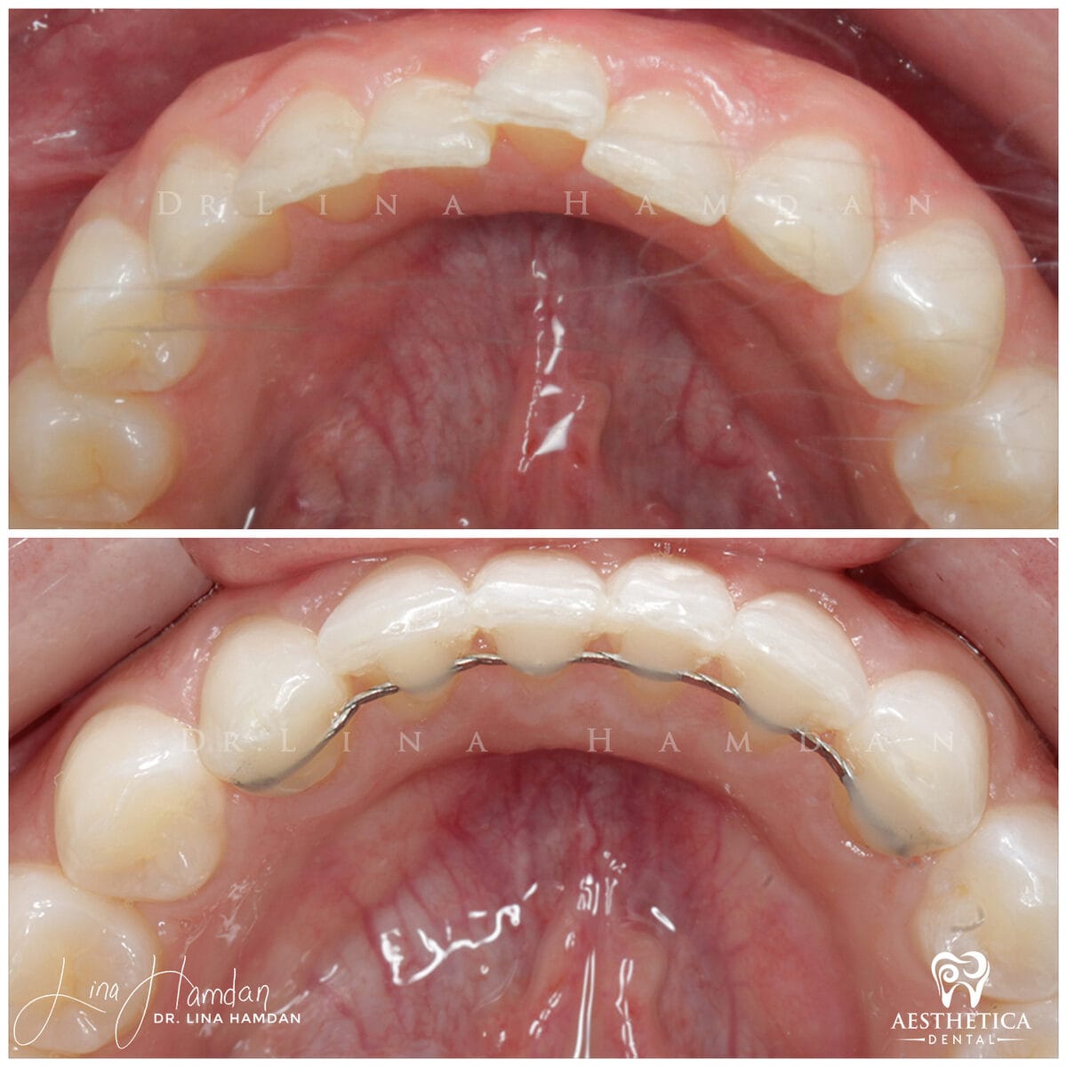Inman aligners: anonymous case 19 from Aesthetica Dental Naperville
