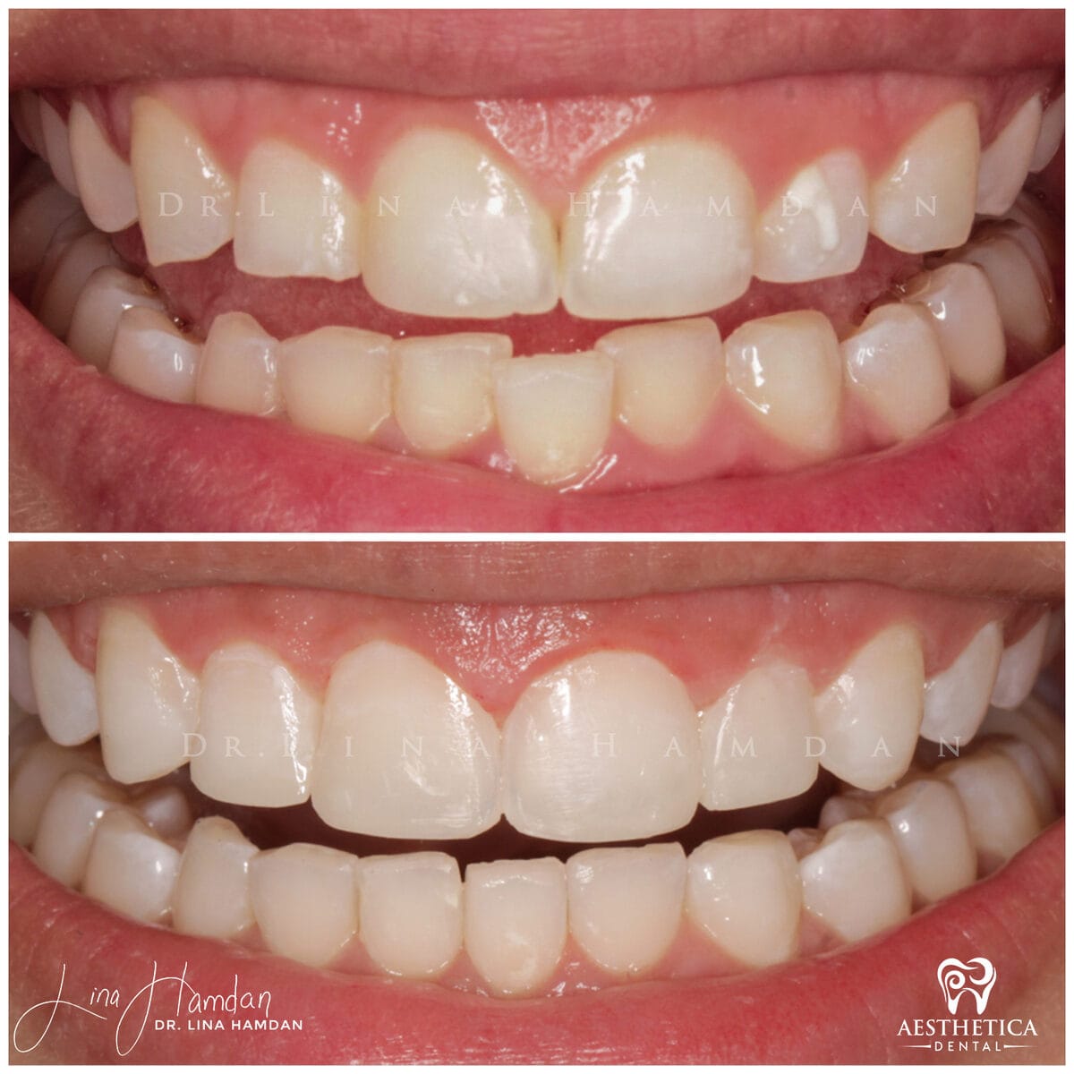 Inman aligners: anonymous case 24 from Aesthetica Dental Naperville
