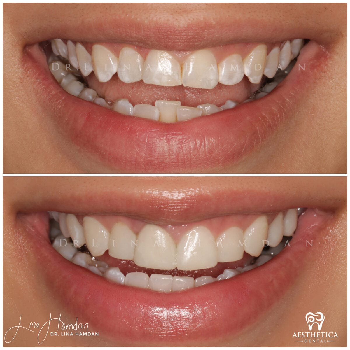 Inman aligners: anonymous case 27 from Aesthetica Dental Naperville