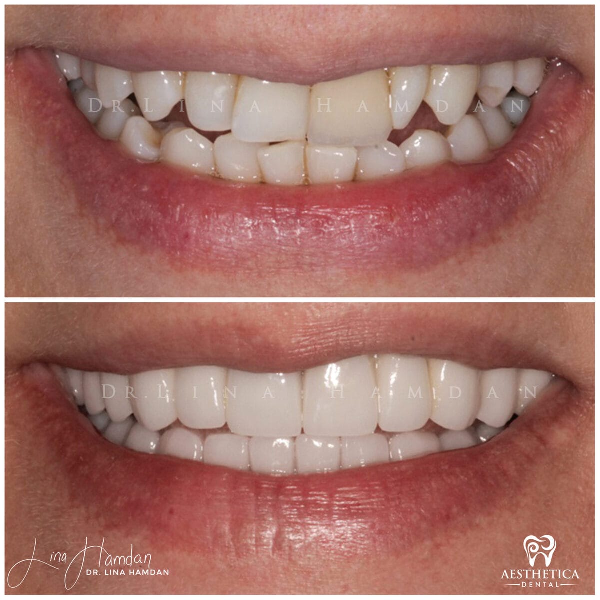 Inman aligners: anonymous case 59 from Aesthetica Dental Naperville