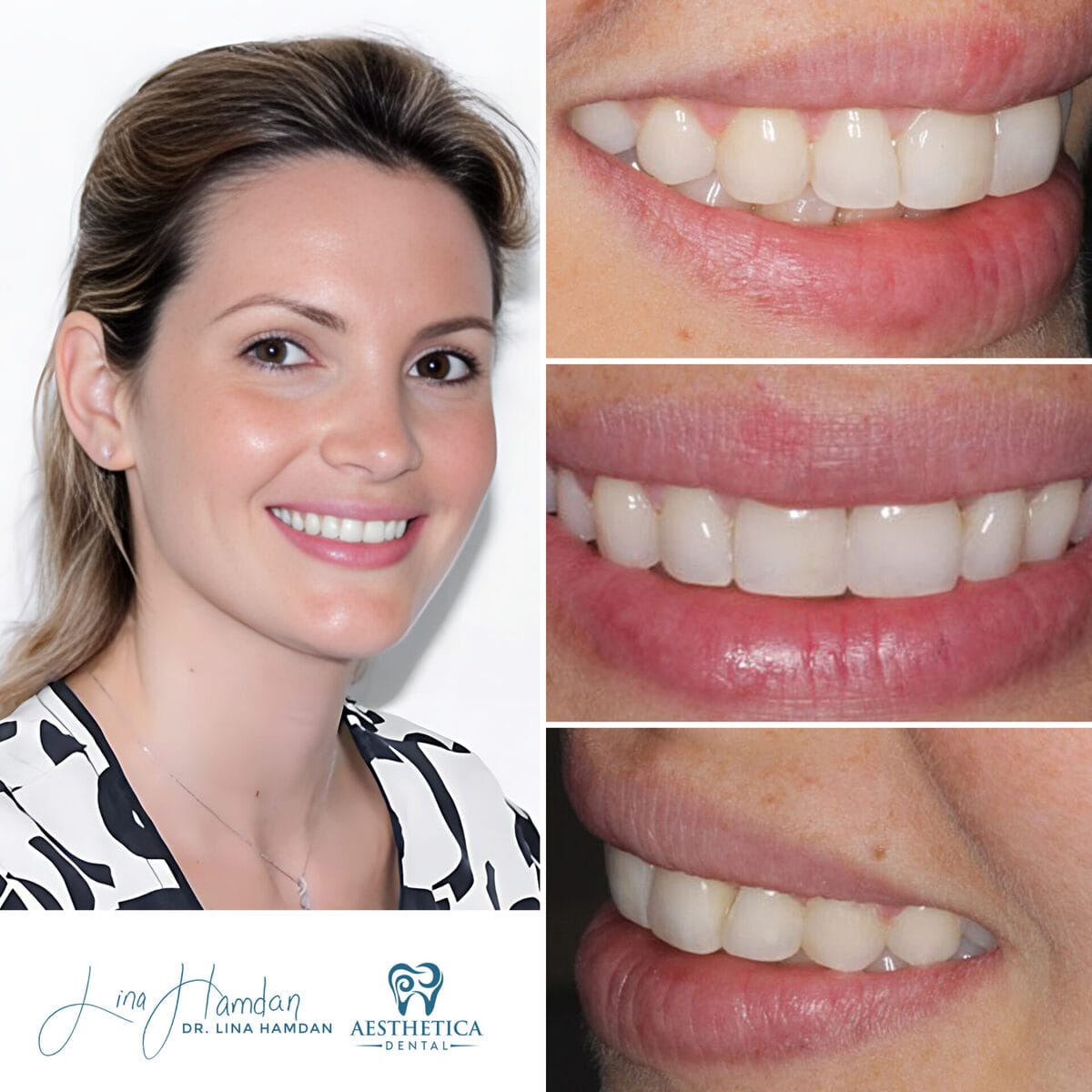 Inman aligners: anonymous case 80 from Aesthetica Dental Naperville