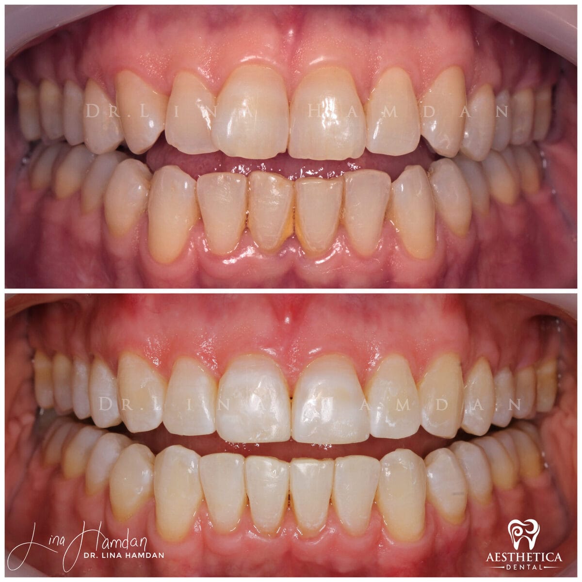 Invisalign clear aligner result, anonymous patient at Aesthetica Dental Naperville (case 2, 2025-01-1-8)