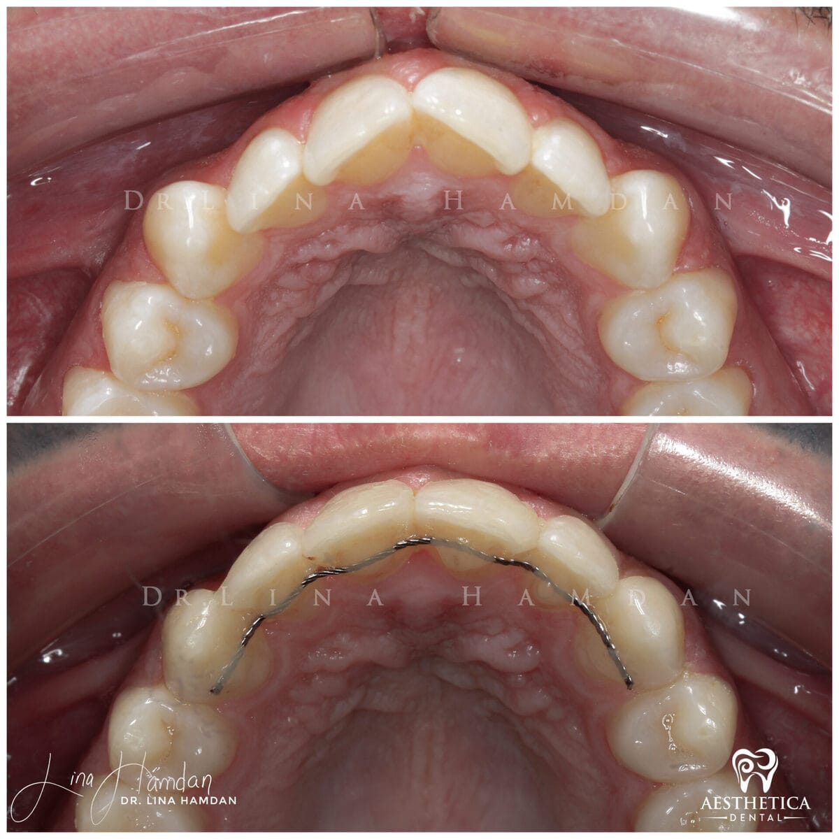 Invisalign clear aligner result, anonymous patient at Aesthetica Dental Naperville (case 11, 2025-01-17-3)