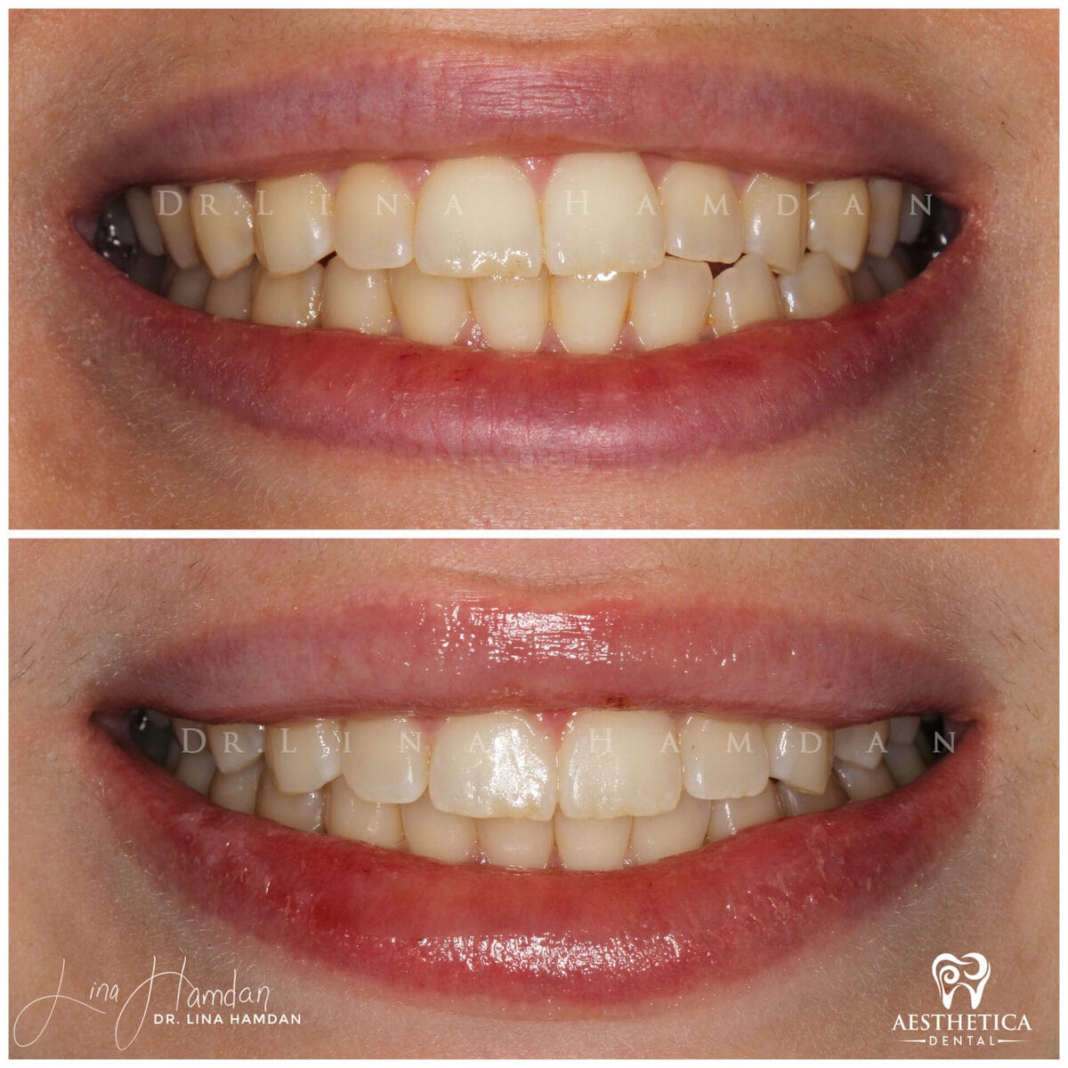 Clear aligners, quietly handled: anonymous case 14 from Aesthetica Dental Naperville