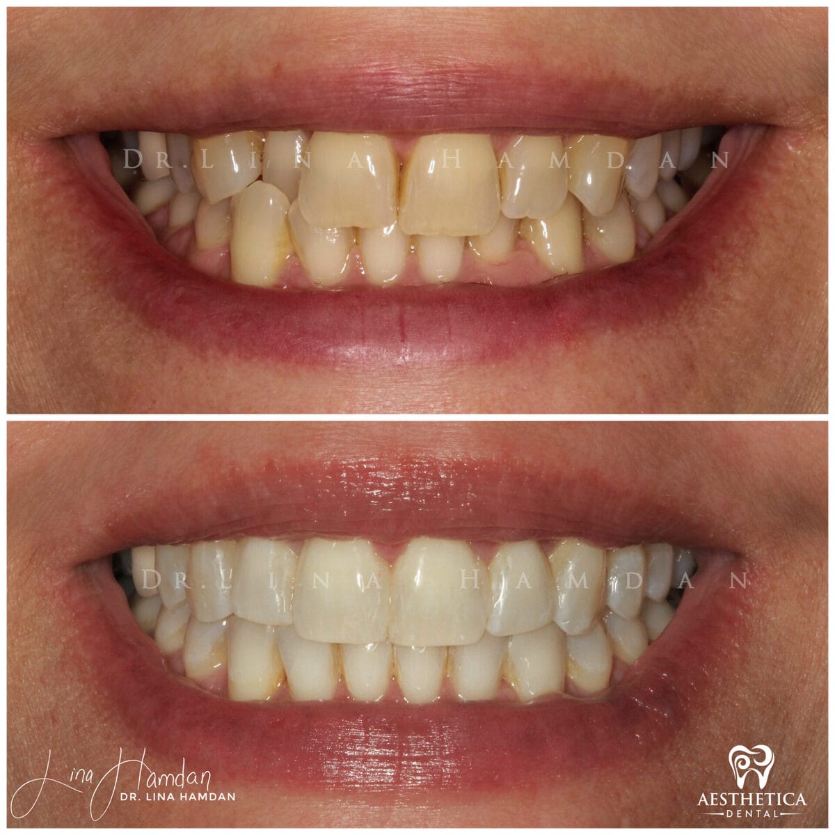 Clear aligners, quietly handled: anonymous case 19 from Aesthetica Dental Naperville