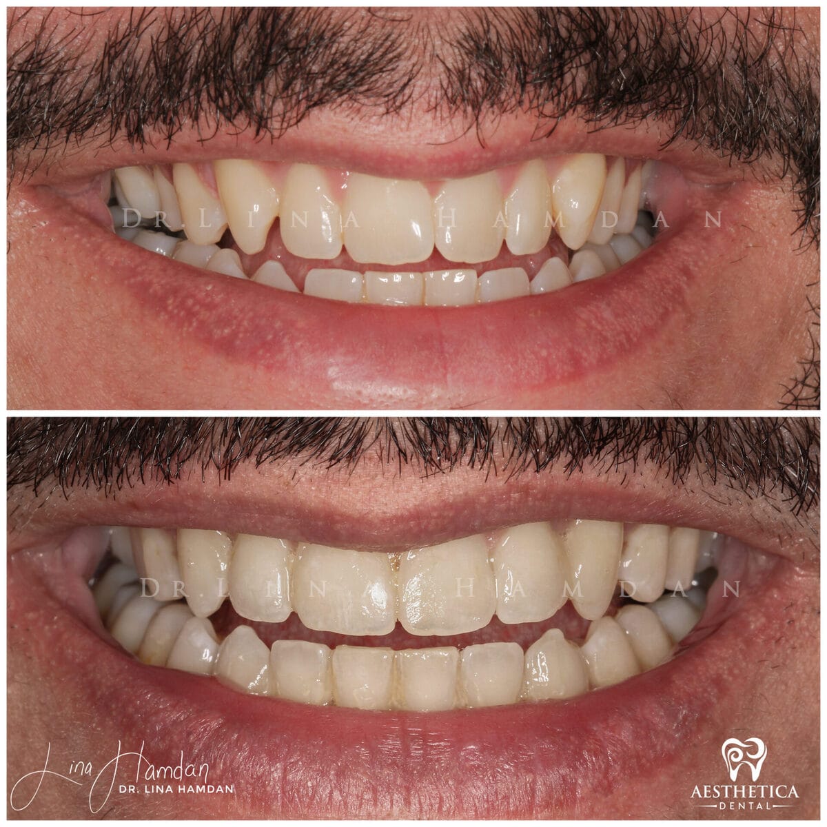 Clear aligners, quietly handled: anonymous case 20 from Aesthetica Dental Naperville