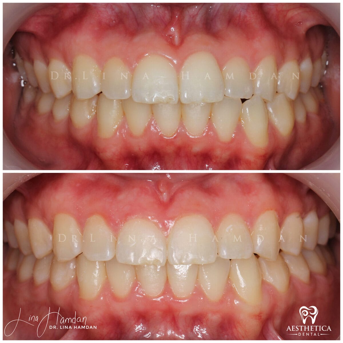 Clear aligners, quietly handled: anonymous case 22 from Aesthetica Dental Naperville