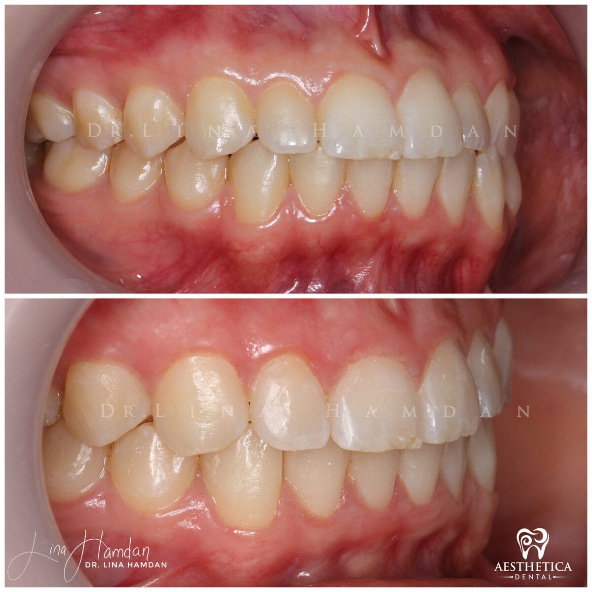 Clear aligners, quietly handled: anonymous case 27 from Aesthetica Dental Naperville