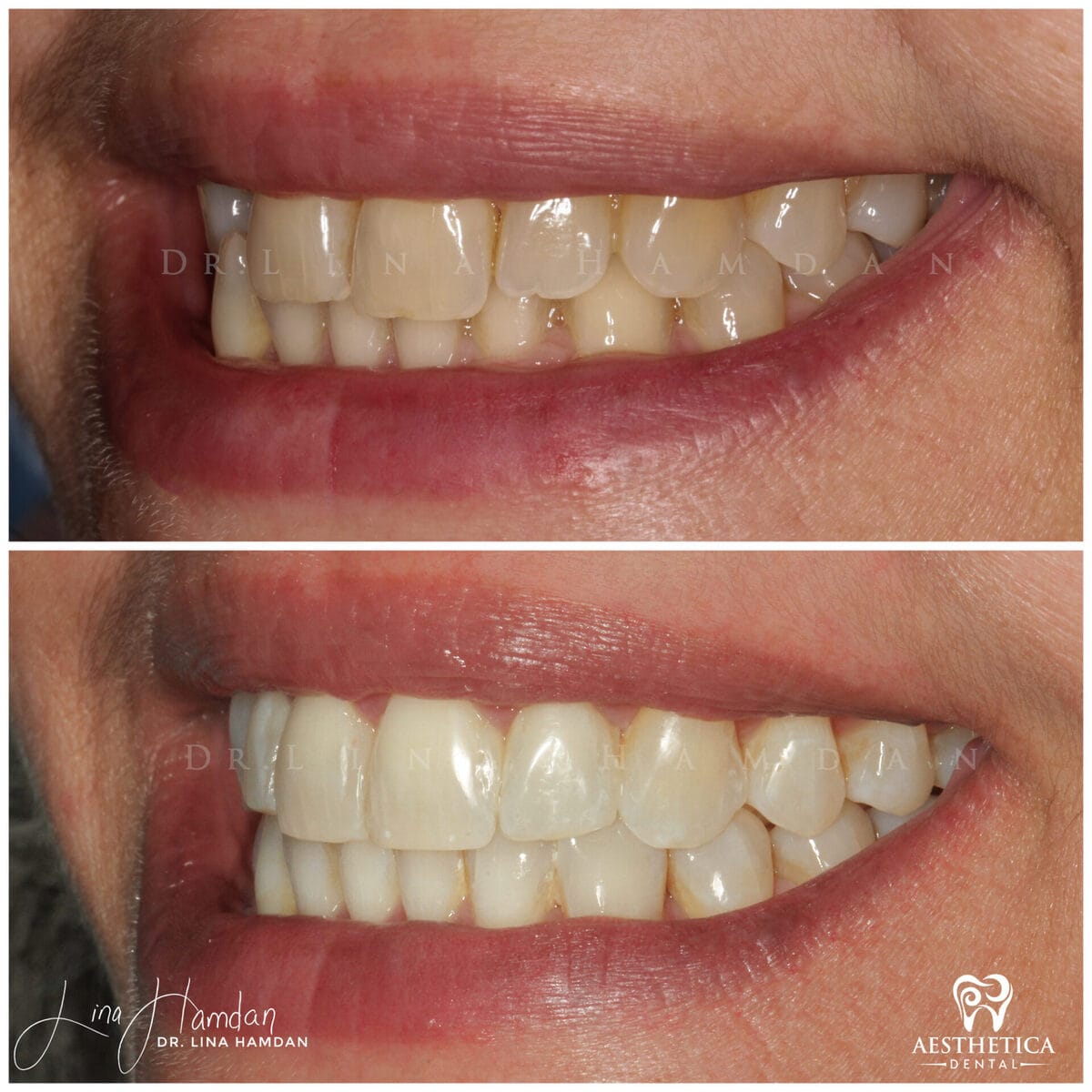 Clear aligners, quietly handled: anonymous case 32 from Aesthetica Dental Naperville