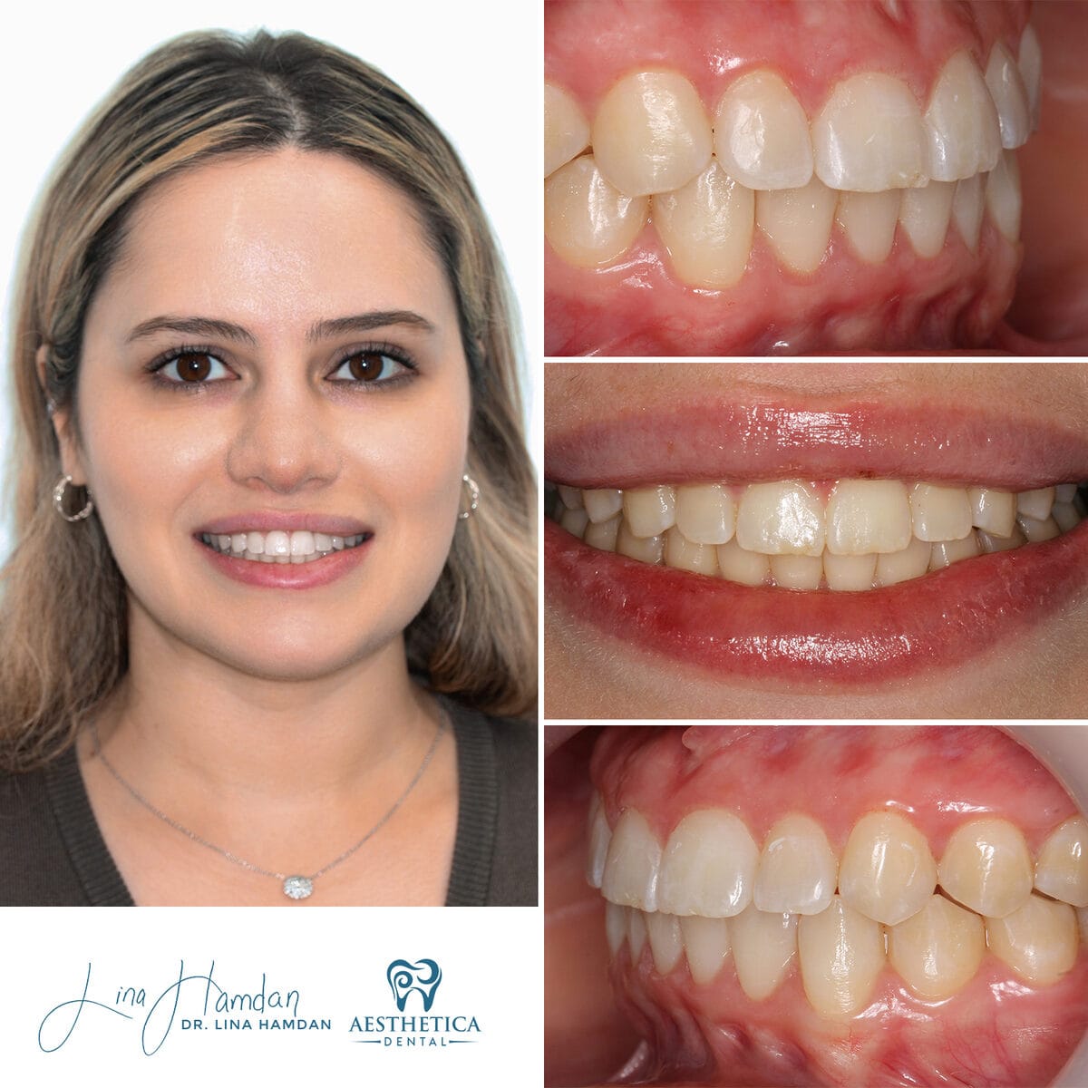 Clear aligners, quietly handled: anonymous case 38 from Aesthetica Dental Naperville