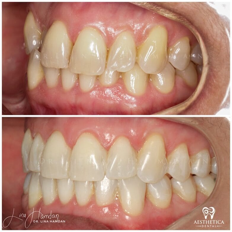 Clear aligners, quietly handled: anonymous case 45 from Aesthetica Dental Naperville