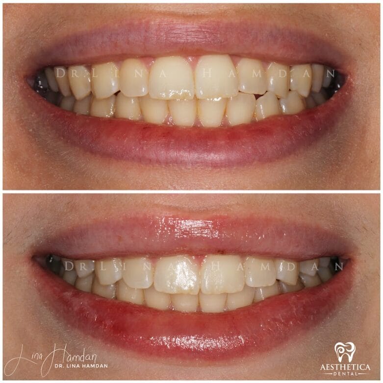 Clear aligners, quietly handled: anonymous case 51 from Aesthetica Dental Naperville
