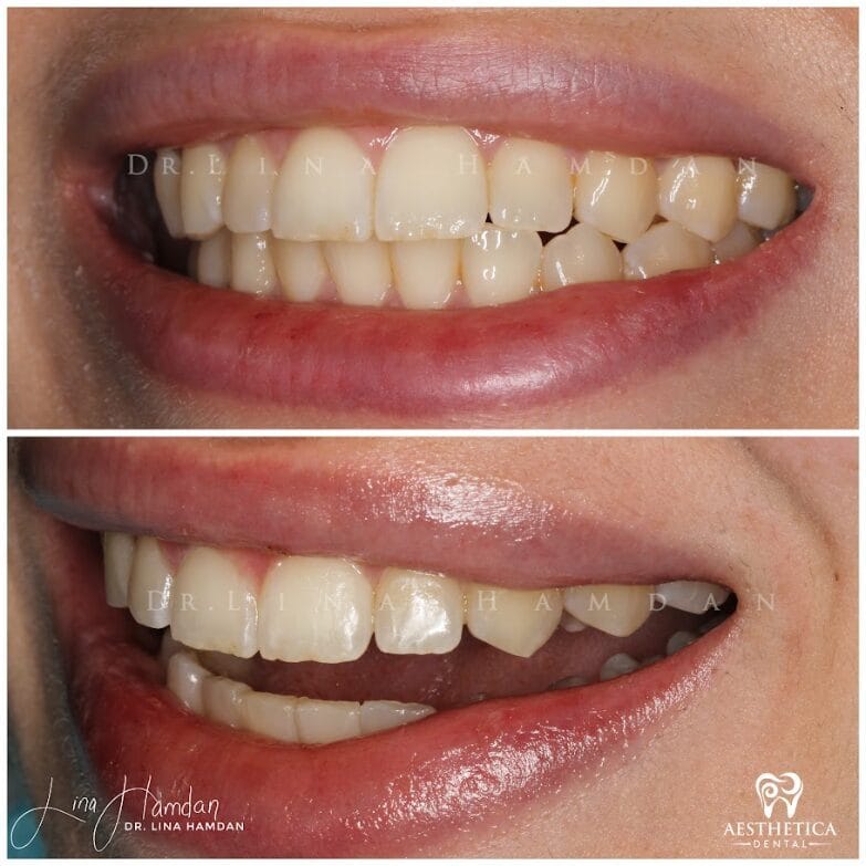 Clear aligners, quietly handled: anonymous case 52 from Aesthetica Dental Naperville