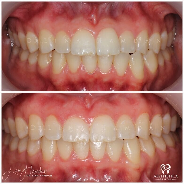 Clear aligners, quietly handled: anonymous case 53 from Aesthetica Dental Naperville