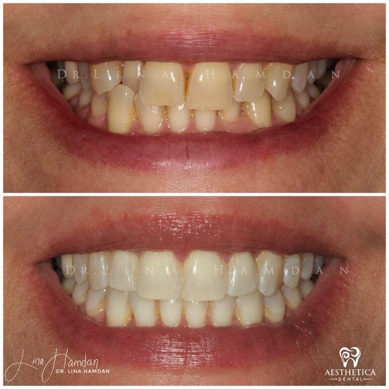 Clear aligners, quietly handled: anonymous case 55 from Aesthetica Dental Naperville