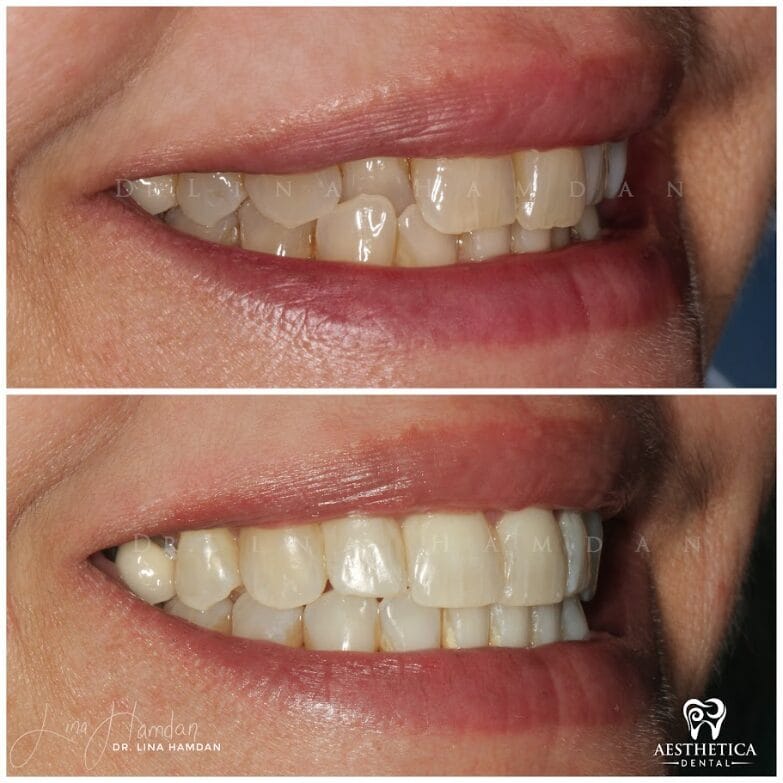 Clear aligners, quietly handled: anonymous case 58 from Aesthetica Dental Naperville