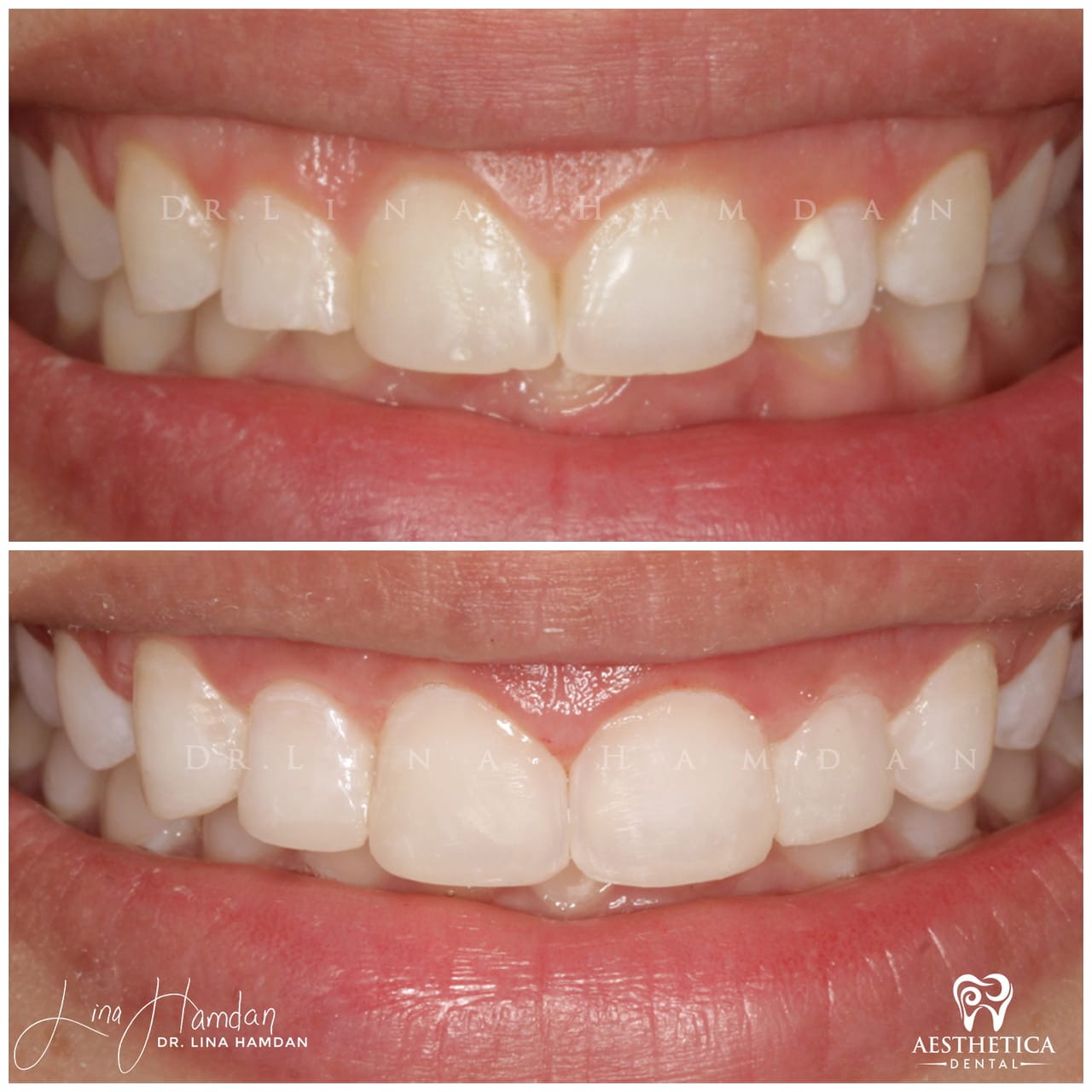 A full re-design of the smile: anonymous case 3 from Aesthetica Dental Naperville