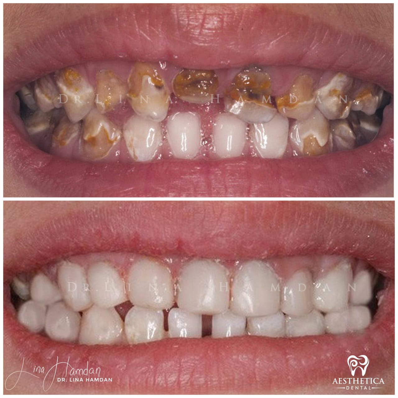 A full re-design of the smile: anonymous case 4 from Aesthetica Dental Naperville