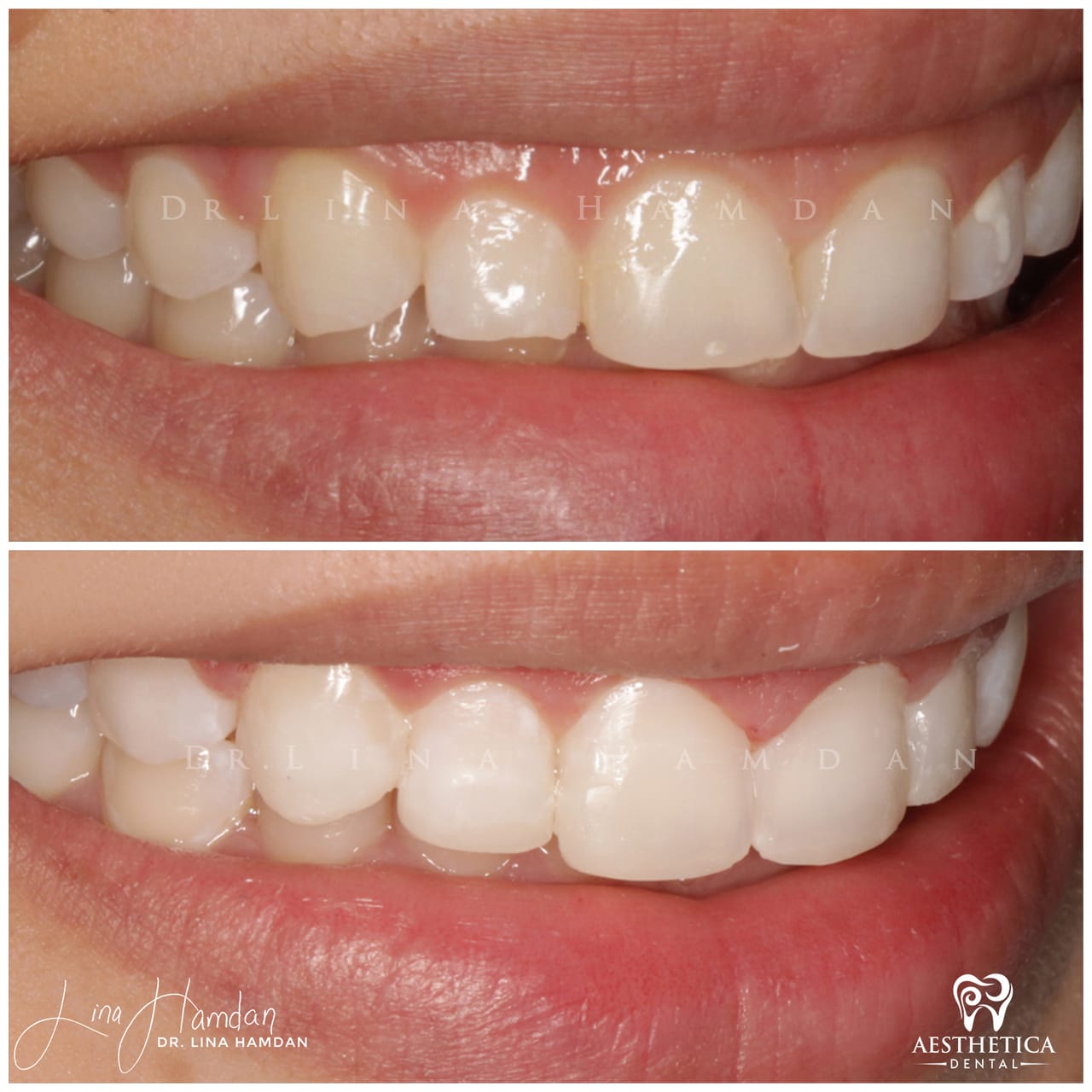 A full re-design of the smile: anonymous case 9 from Aesthetica Dental Naperville