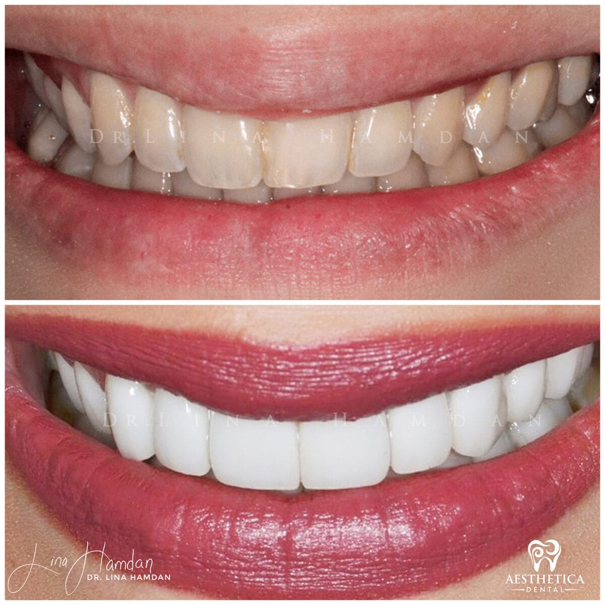 Considered porcelain veneers. · Plainfield