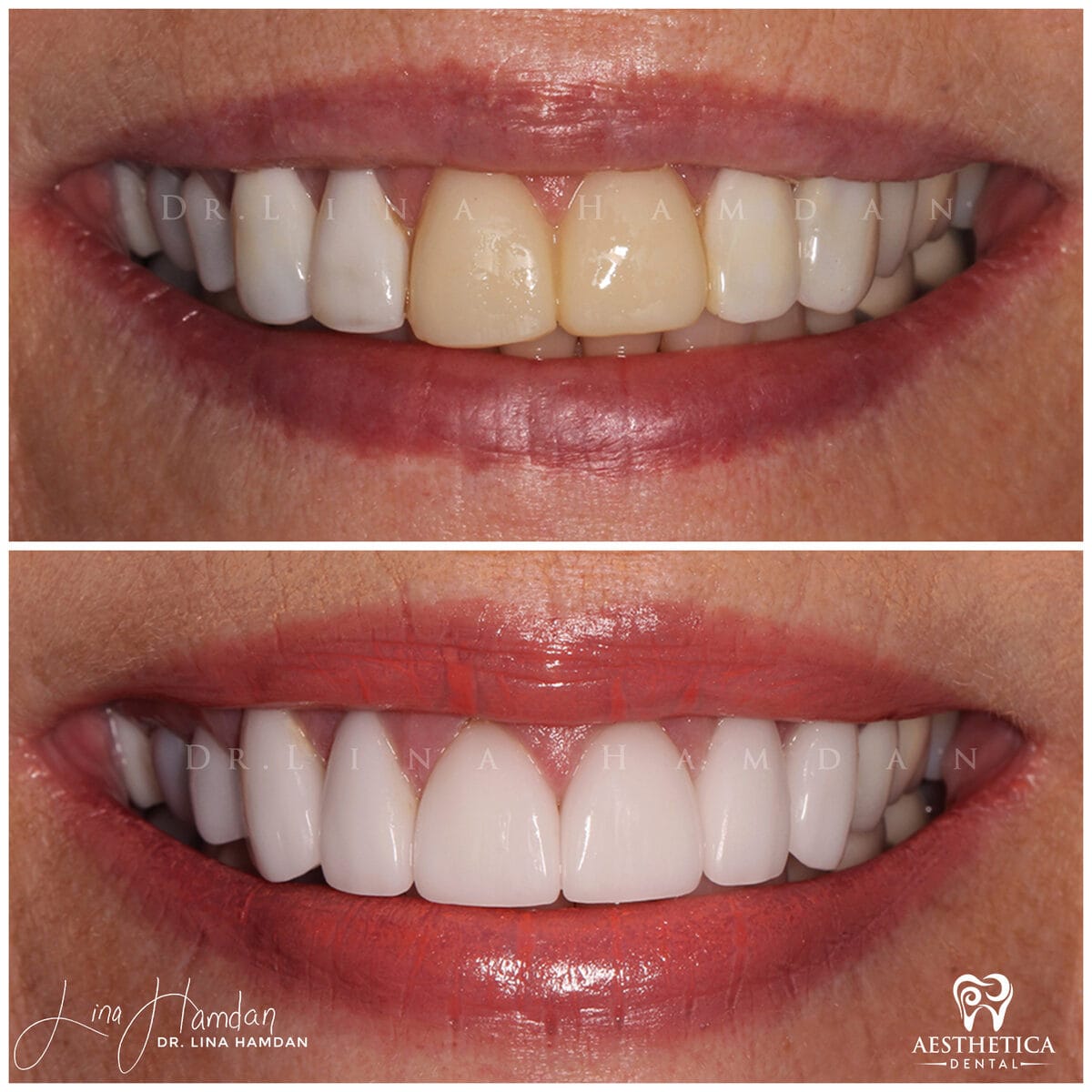 Considered porcelain veneers. · Plainfield