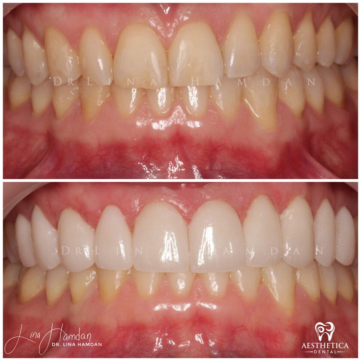 Considered porcelain veneers. · Plainfield