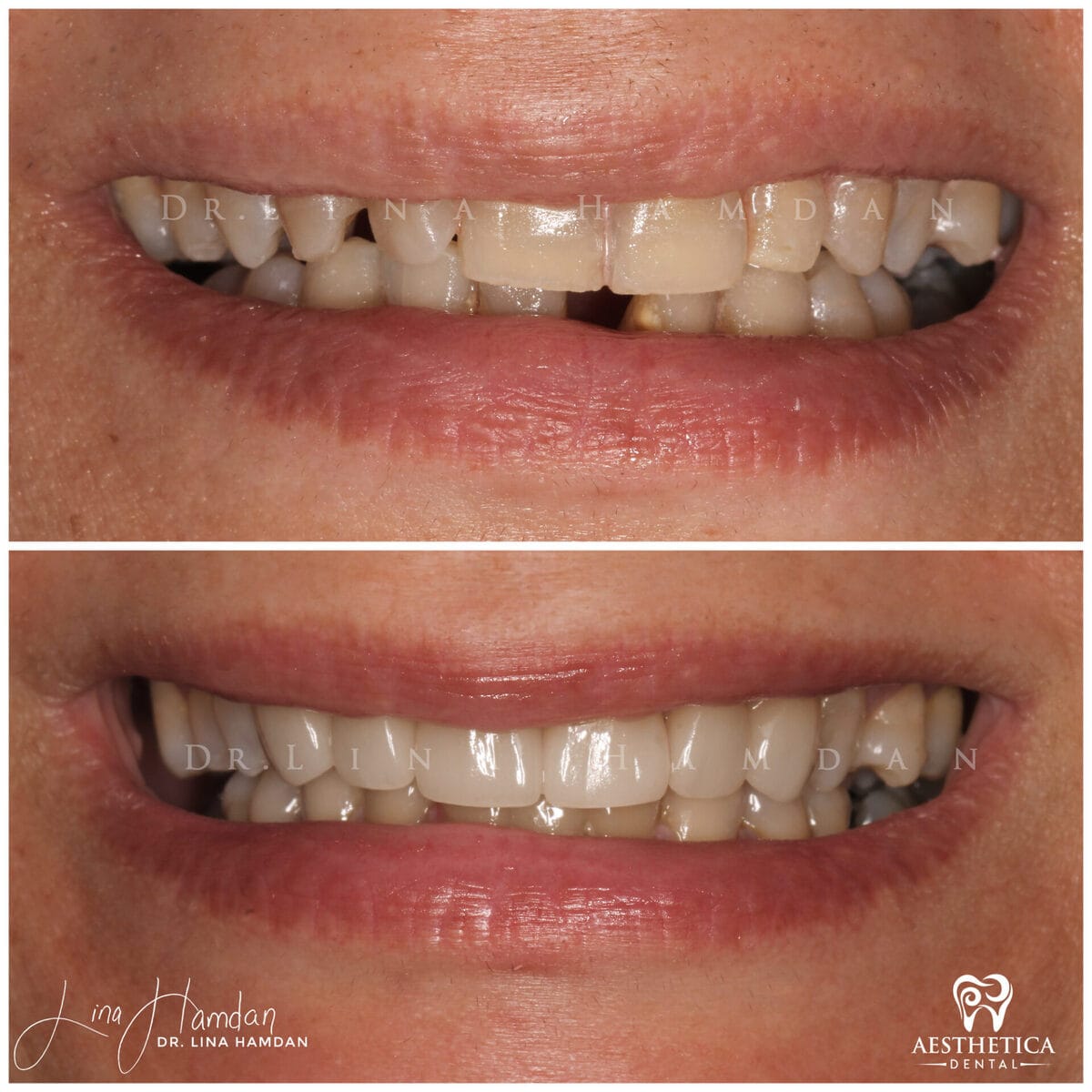 Considered porcelain veneers. · Plainfield