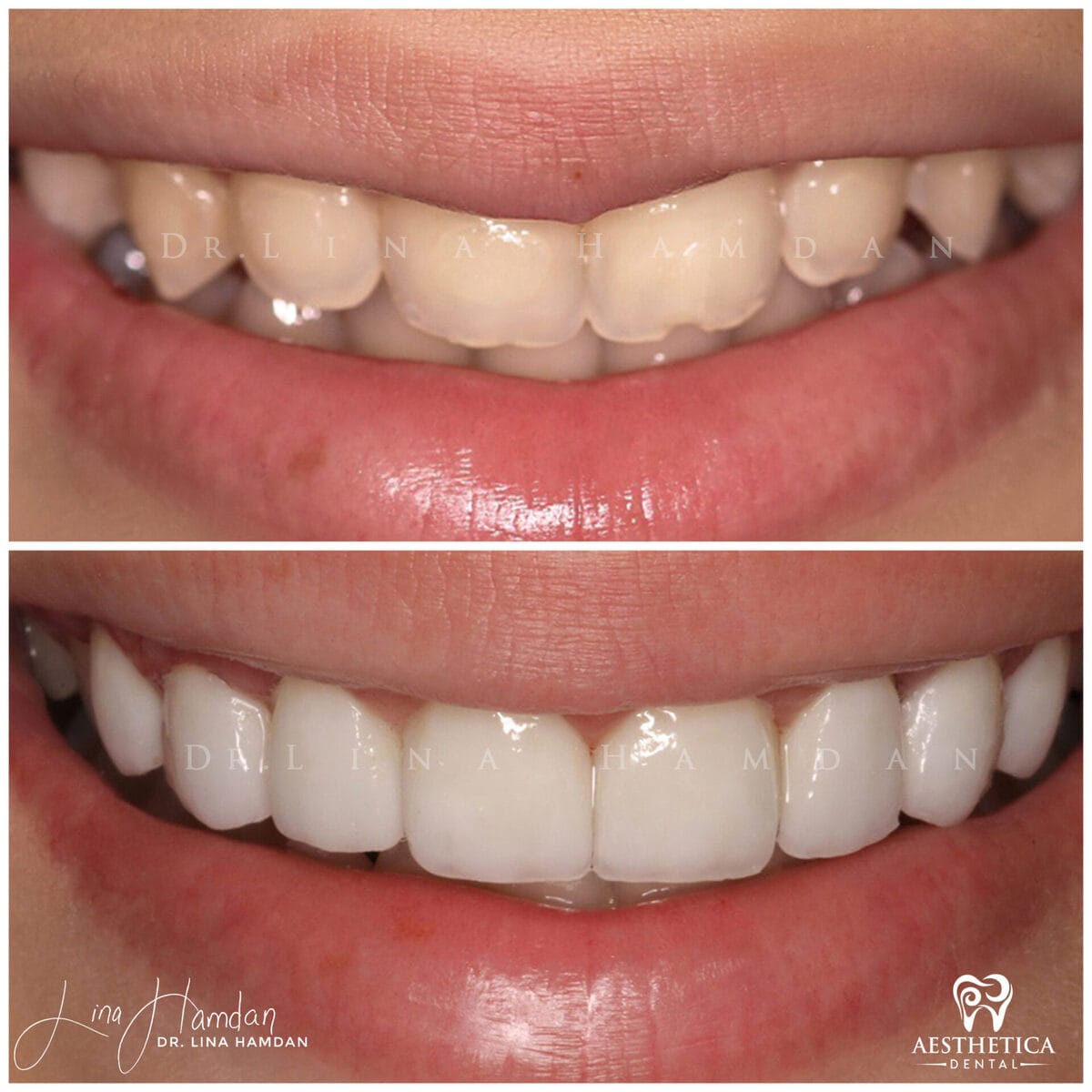 Considered porcelain veneers: anonymous case 11 from Aesthetica Dental Naperville