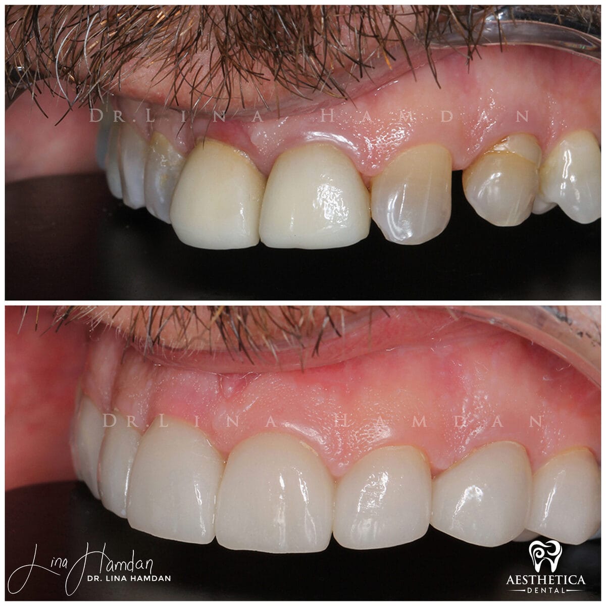 Considered porcelain veneers: anonymous case 12 from Aesthetica Dental Naperville