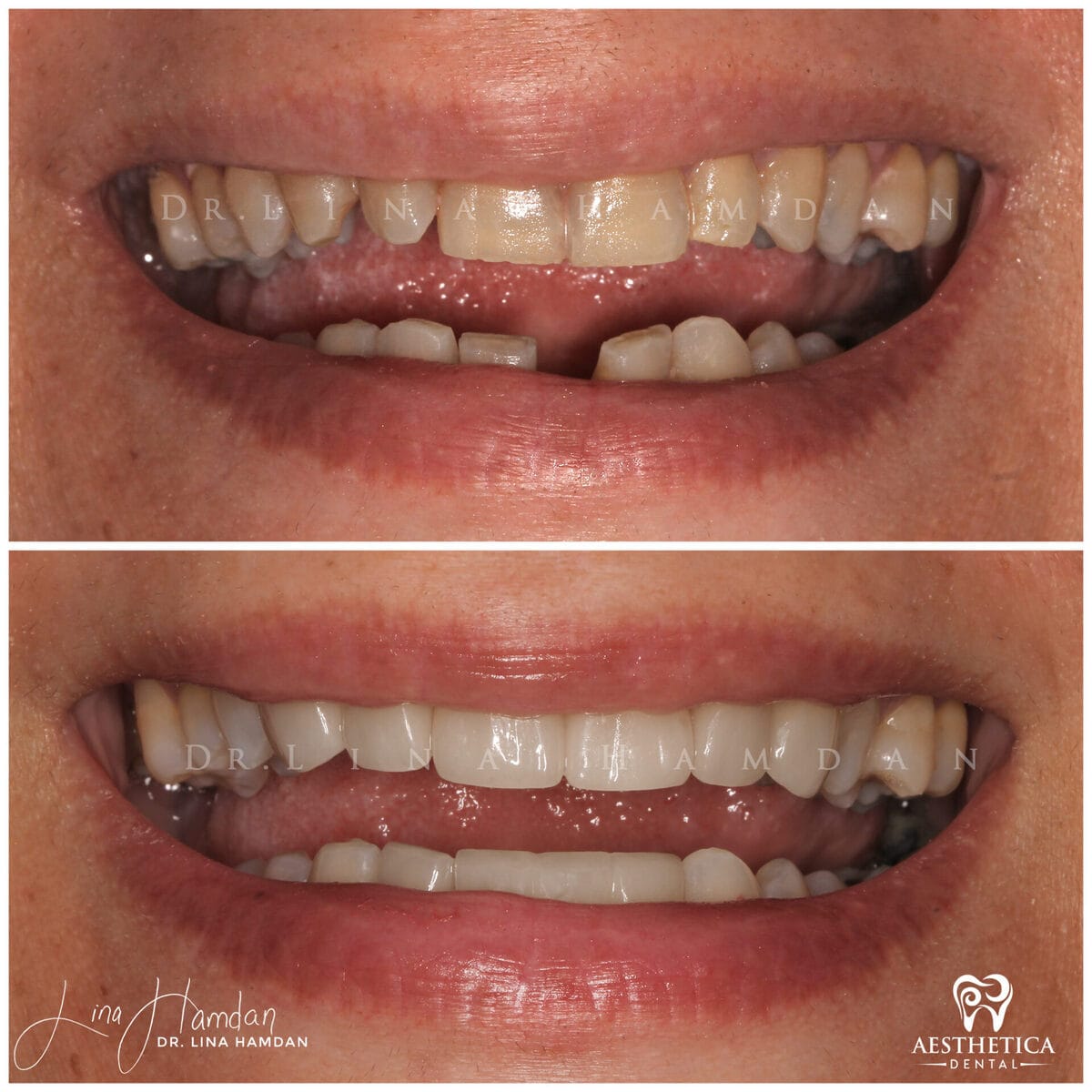 Considered porcelain veneers: anonymous case 26 from Aesthetica Dental Naperville