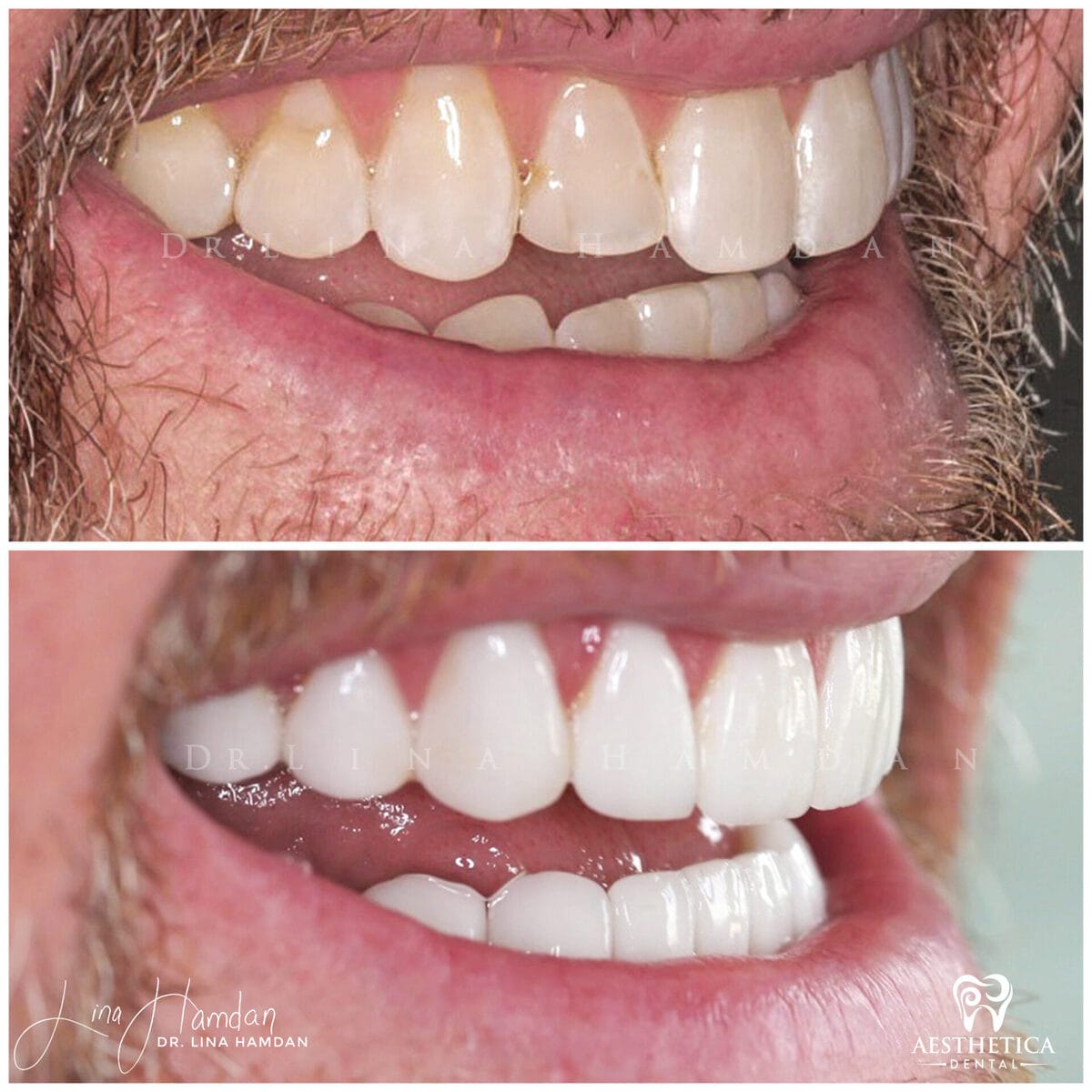 Considered porcelain veneers: anonymous case 28 from Aesthetica Dental Naperville