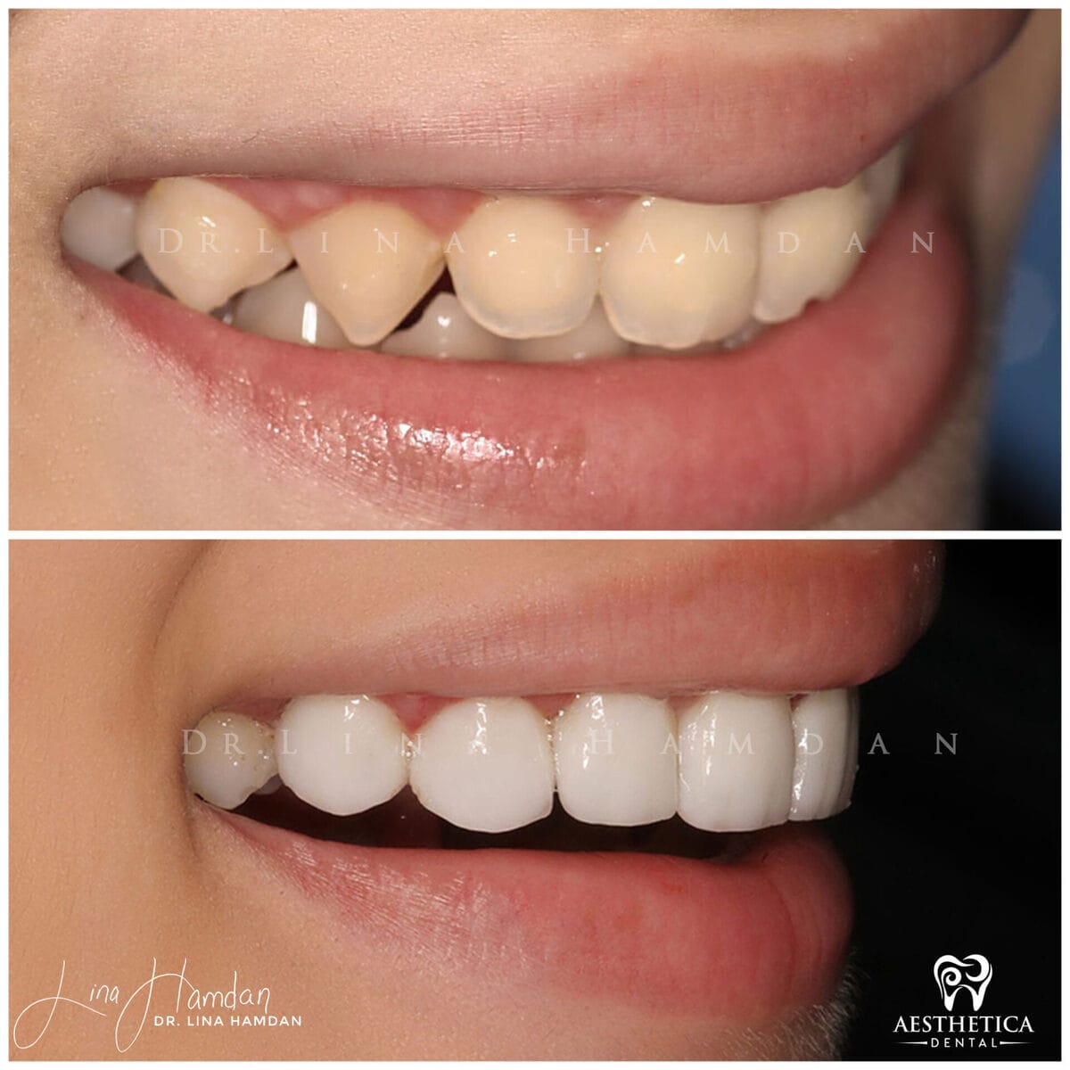 Considered porcelain veneers: anonymous case 38 from Aesthetica Dental Naperville