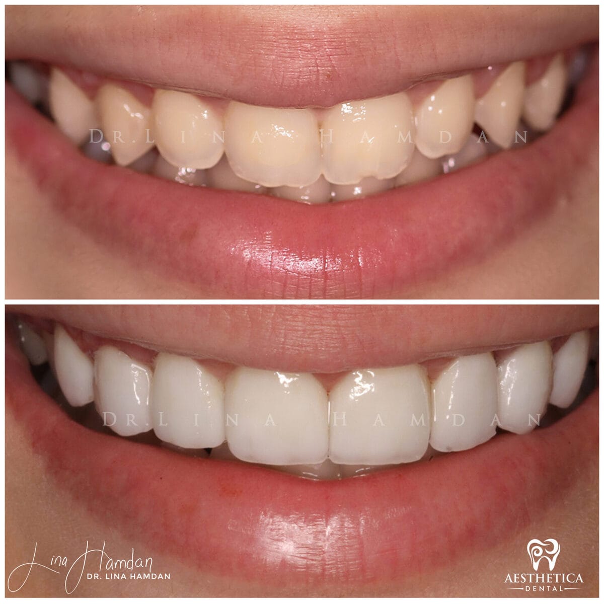 Considered porcelain veneers: anonymous case 45 from Aesthetica Dental Naperville