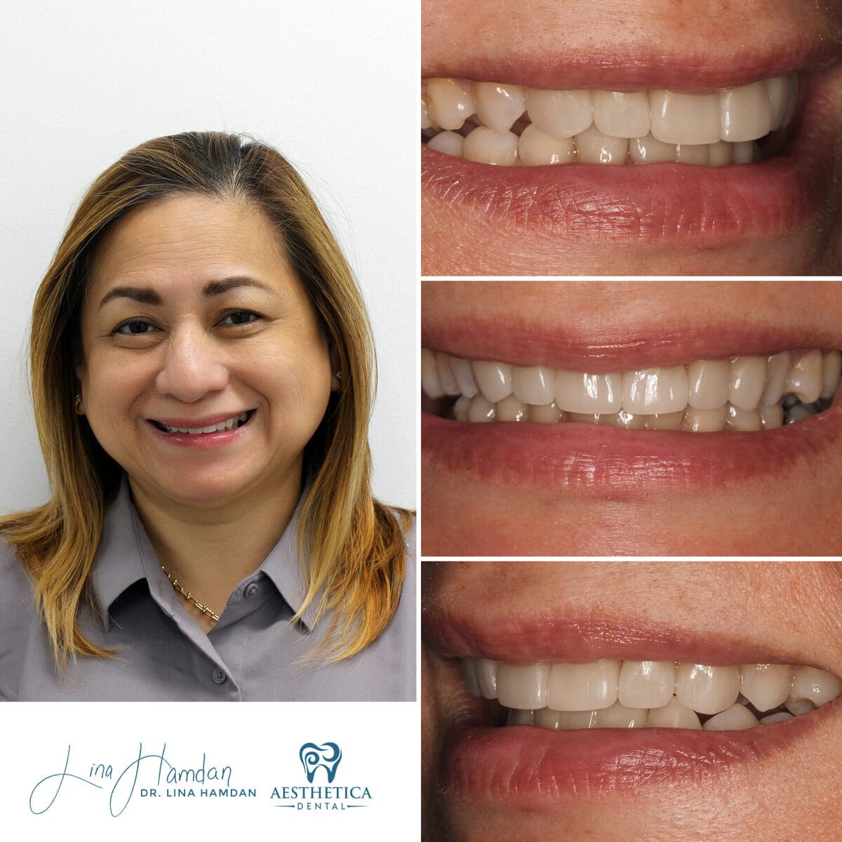 Considered porcelain veneers: anonymous case 61 from Aesthetica Dental Naperville