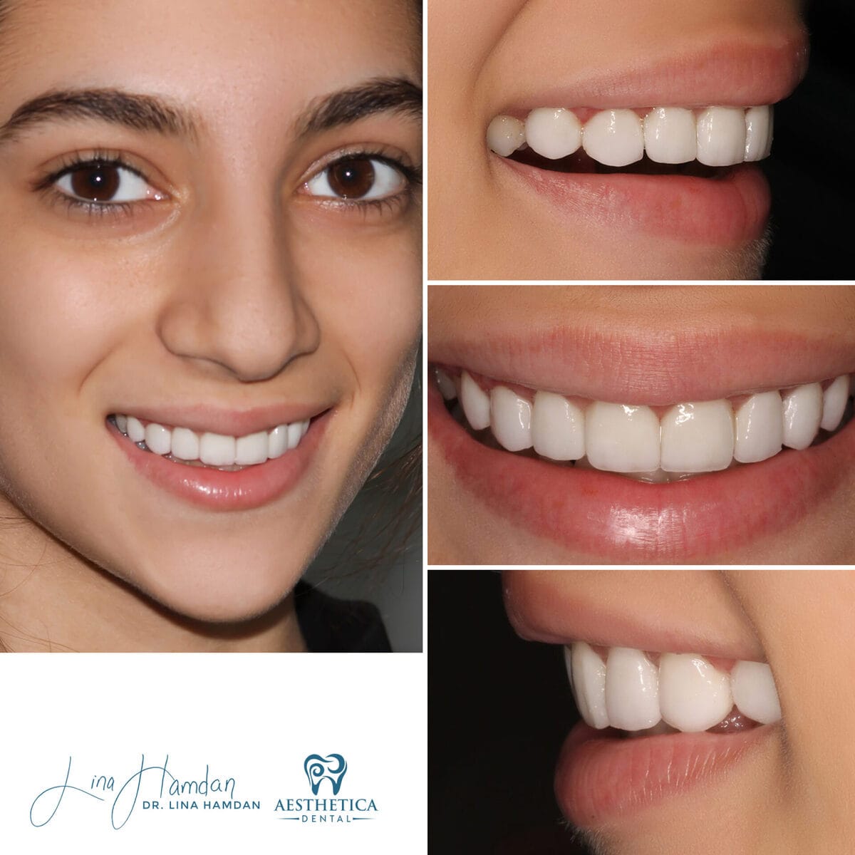 Considered porcelain veneers: anonymous case 74 from Aesthetica Dental Naperville